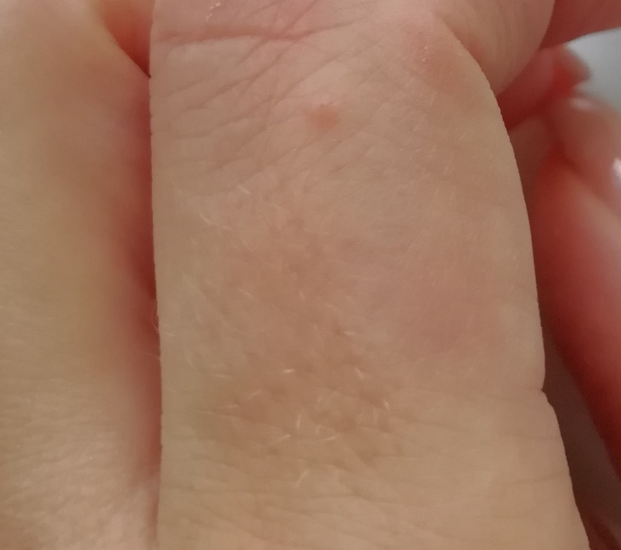 Контактный дерматит на пальцах рук фото