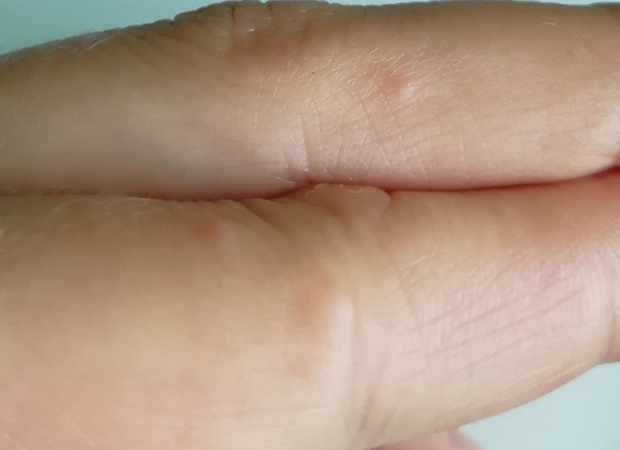 Причины появления жжения в пальцах рук и факторы риска