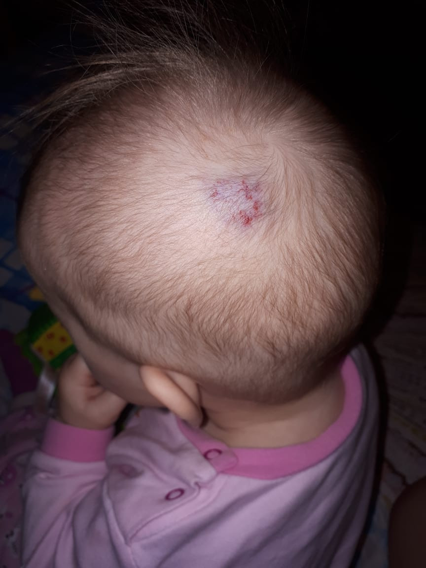 Гемангиома на голове у ребенка фото