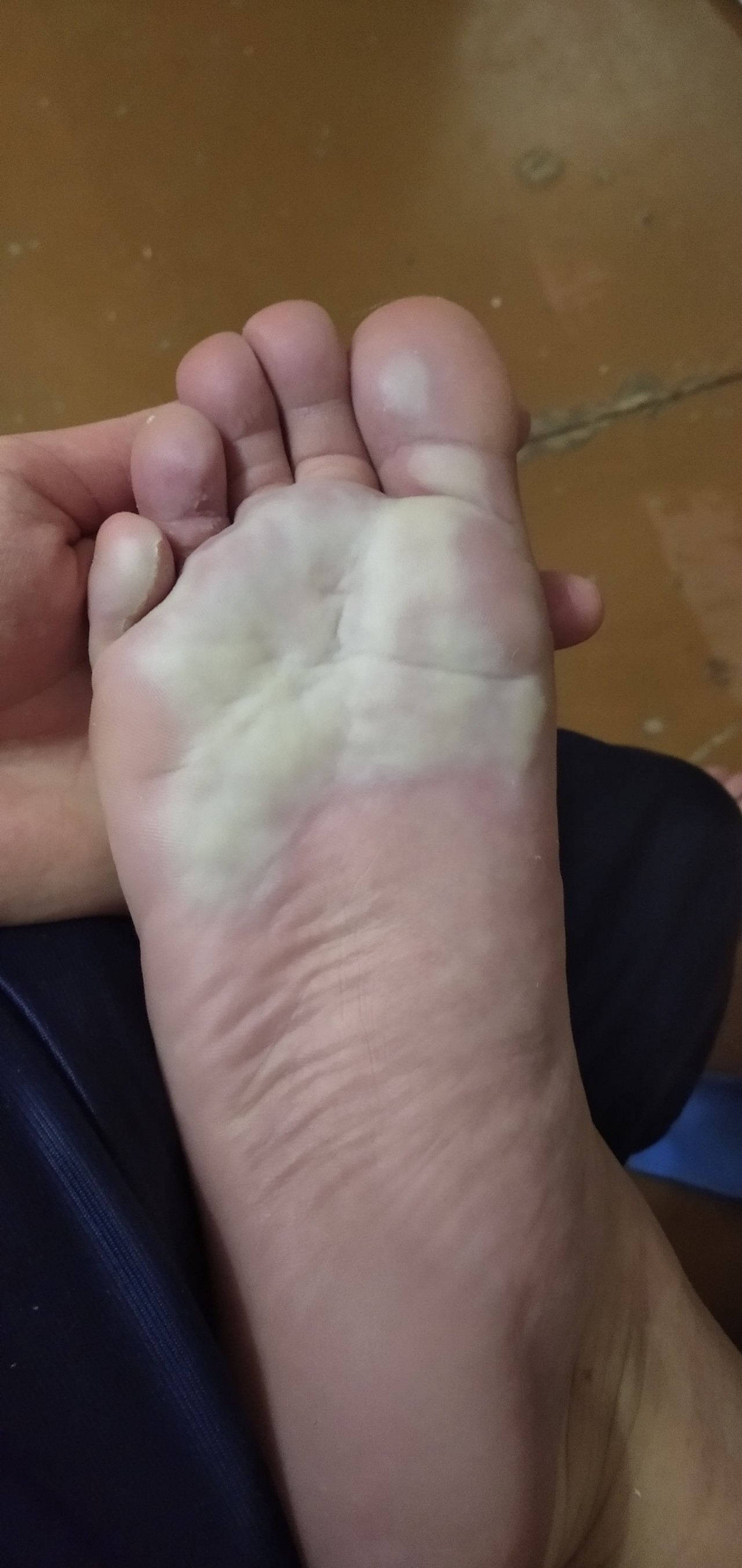 Микоз стоп (грибок на ногах) - как выглядит, причины, симптомы и лечение