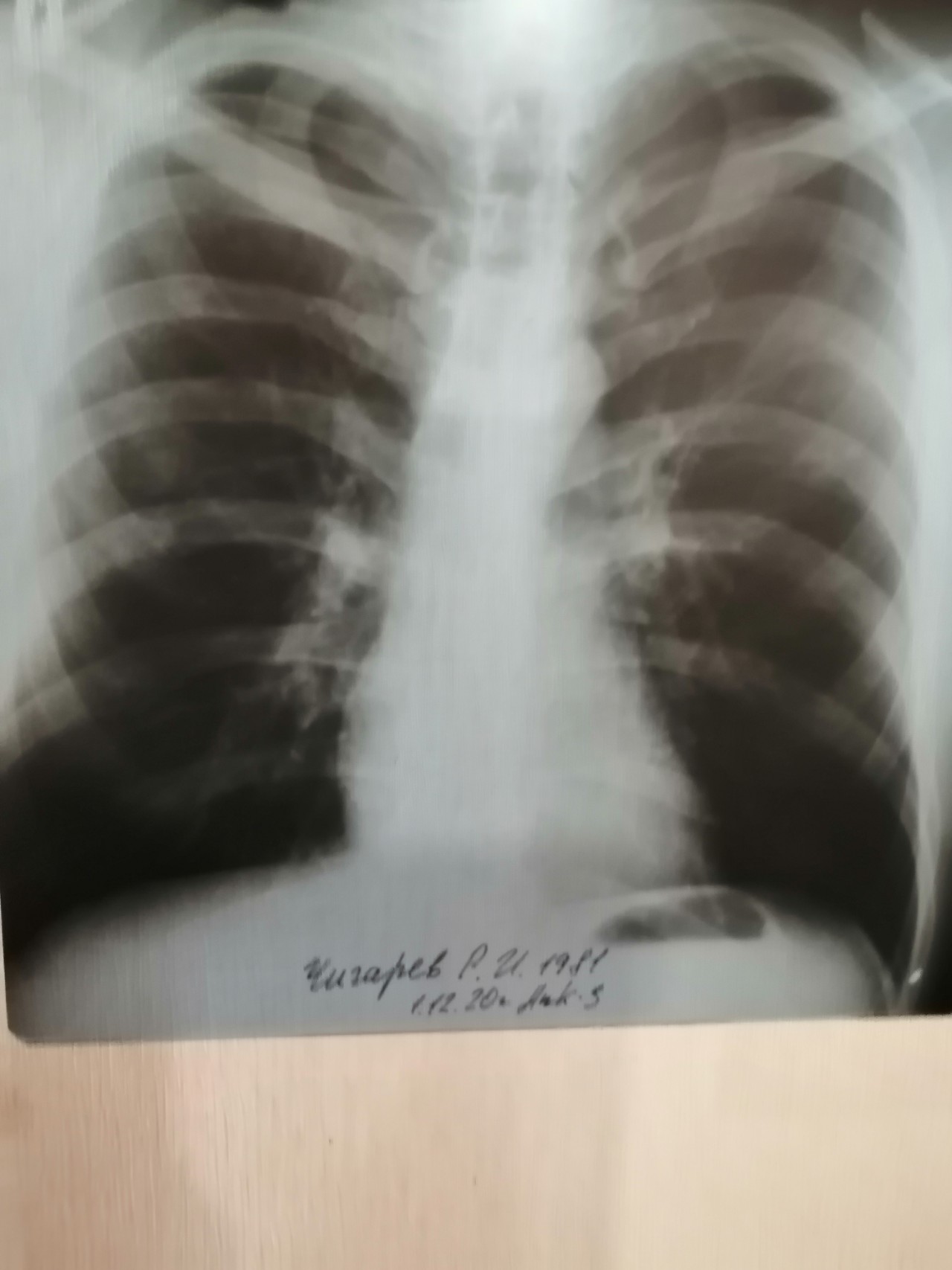 Снимок лёгких при туберкулезе фото. 69 % Поражение лёгких. Инфертивное поражение легких. Поражение легких 3