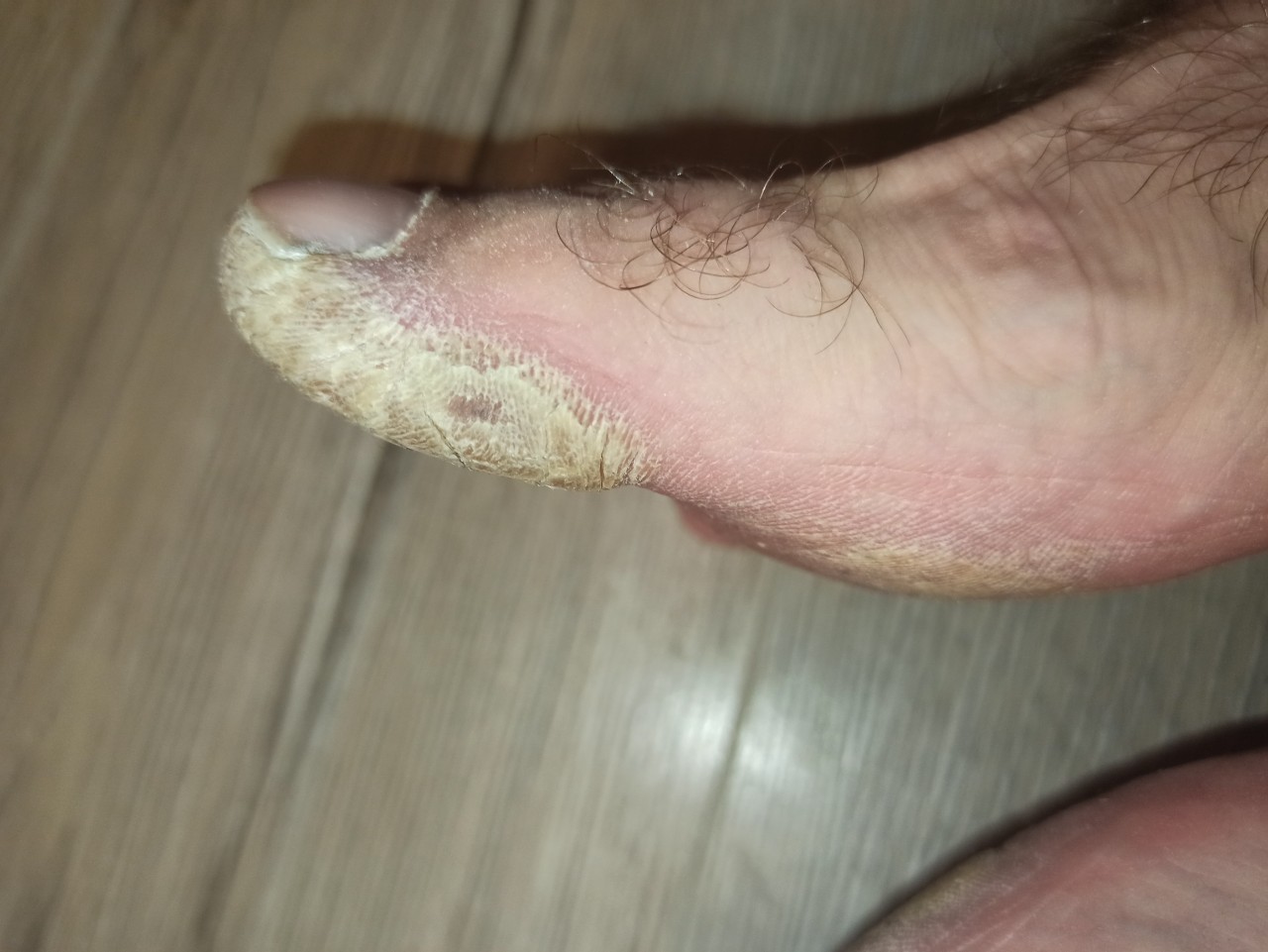 Способы лечения трещин на коже ног