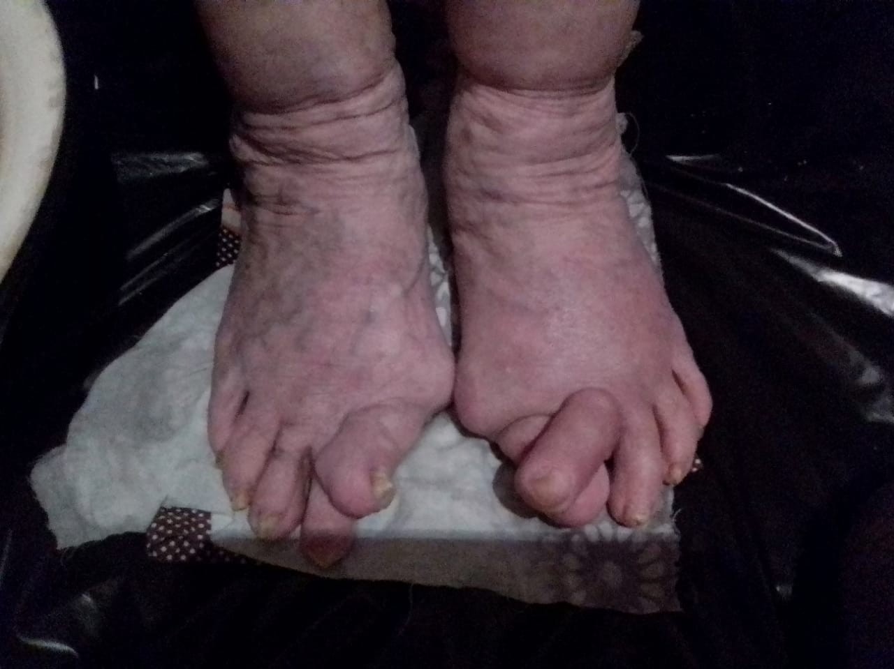 Боли в пальцах ног могут наблюдаться при разнообразных заболеваниях: