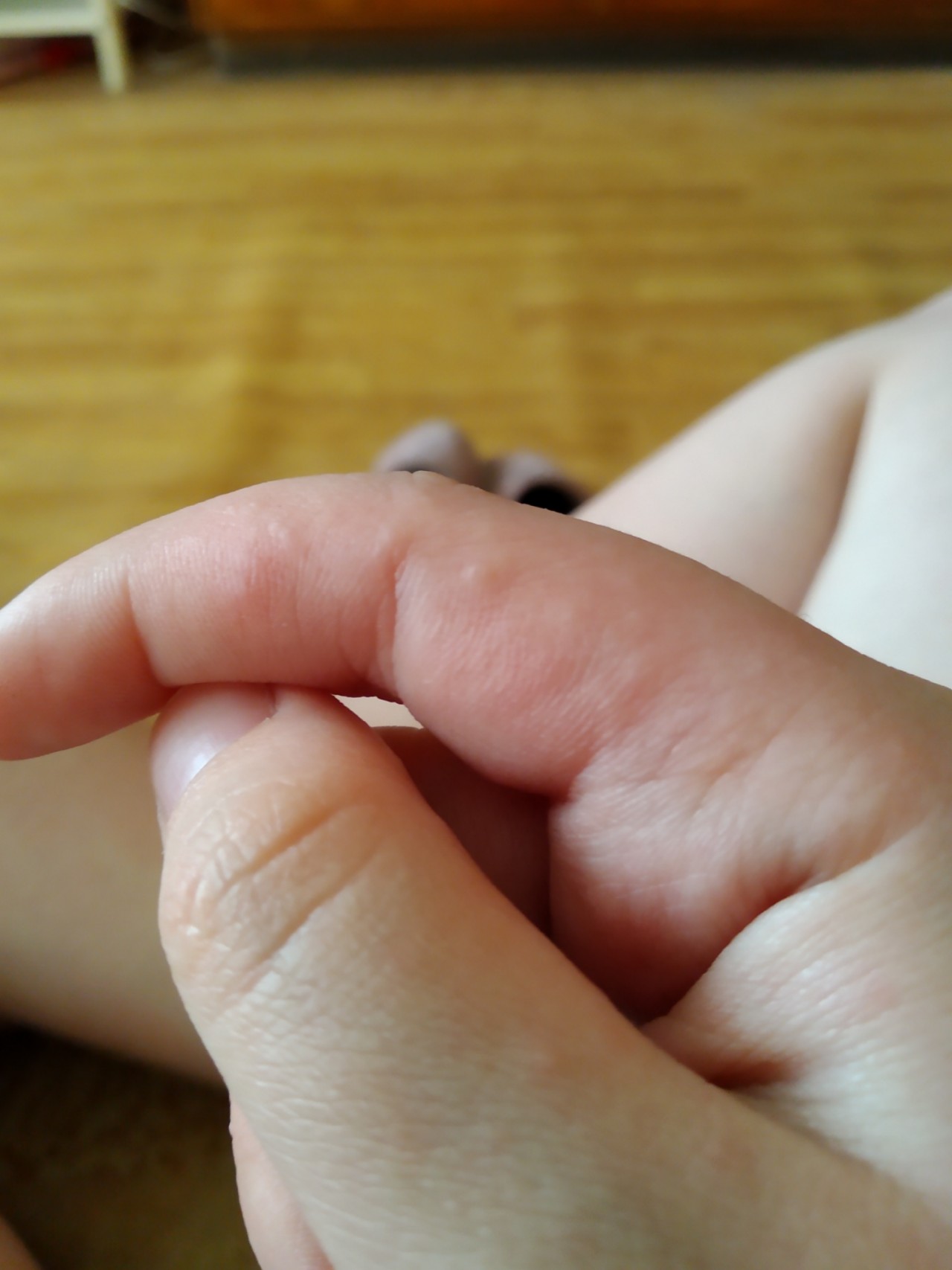 Сыпь на указательном пальце