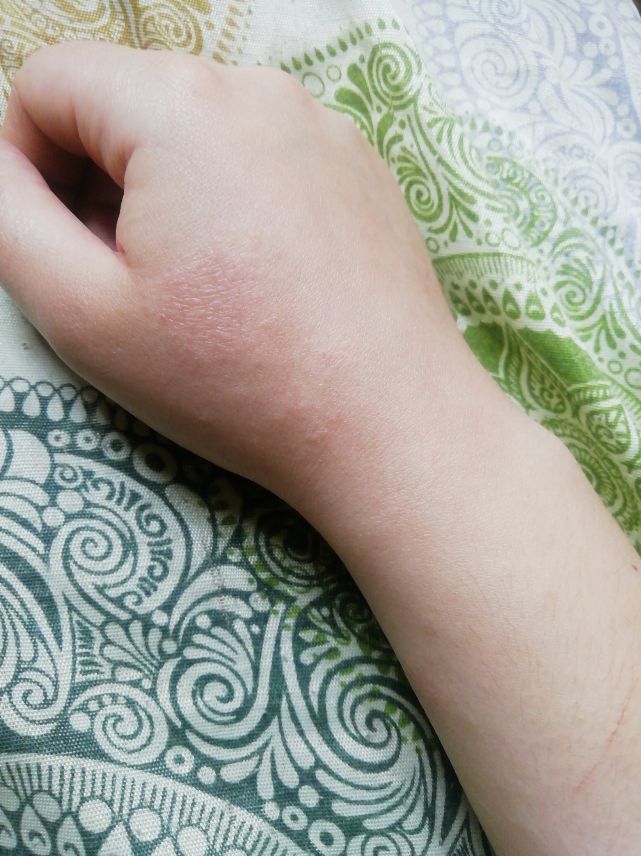 аллергия красные пятна на теле фото