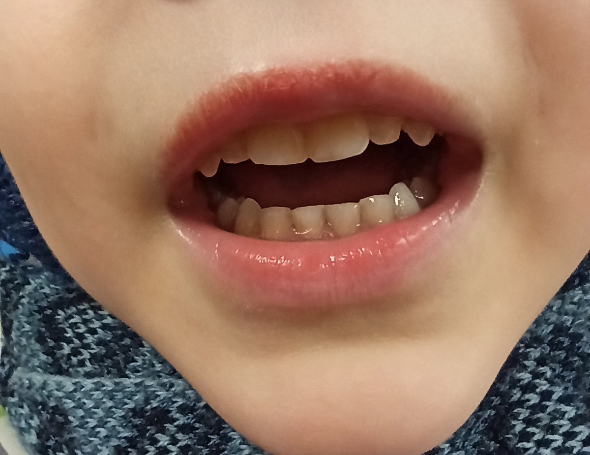 Красная кайма губ у ребенка