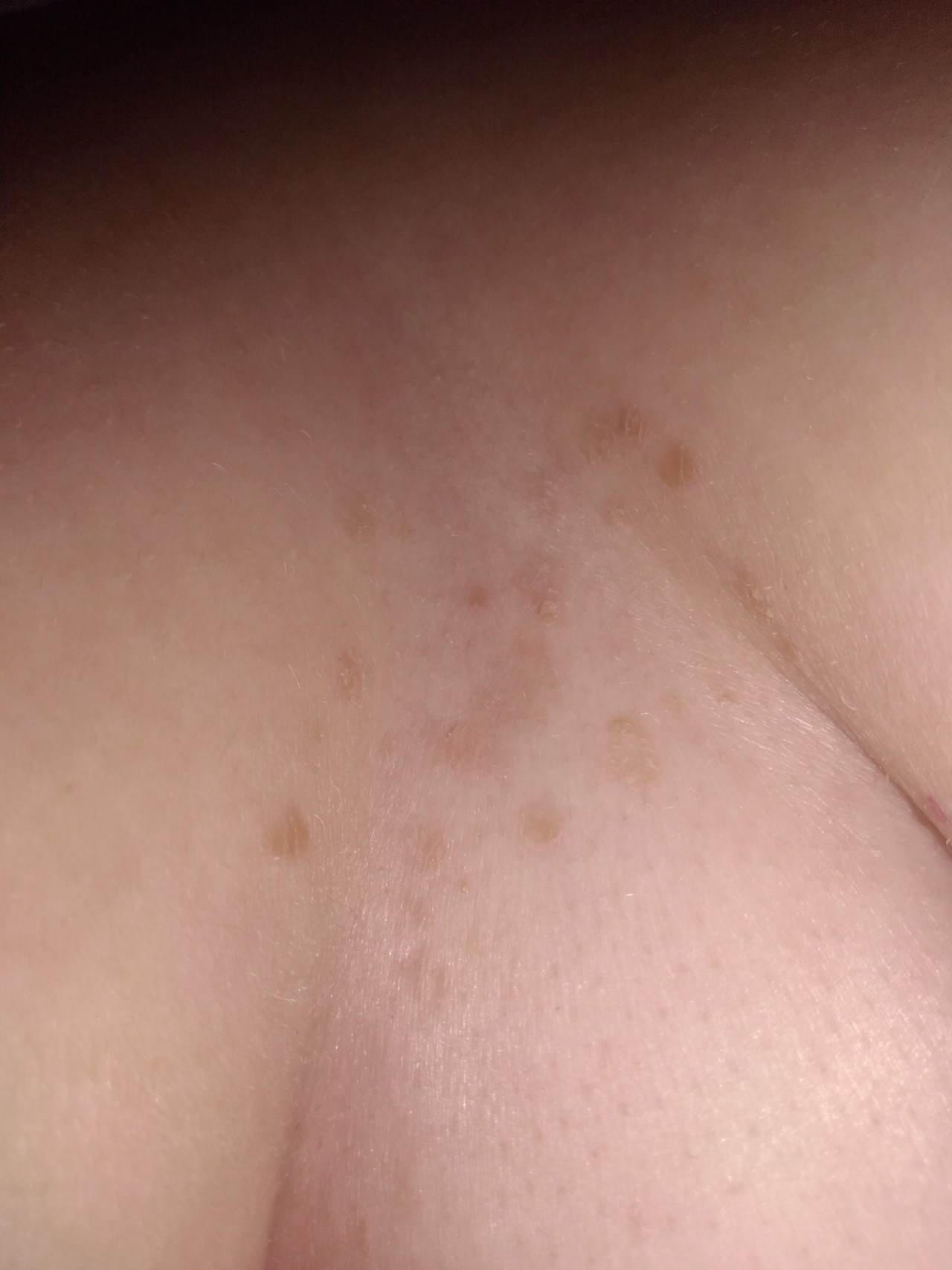 сыпь на груди чешется у женщин фото 106