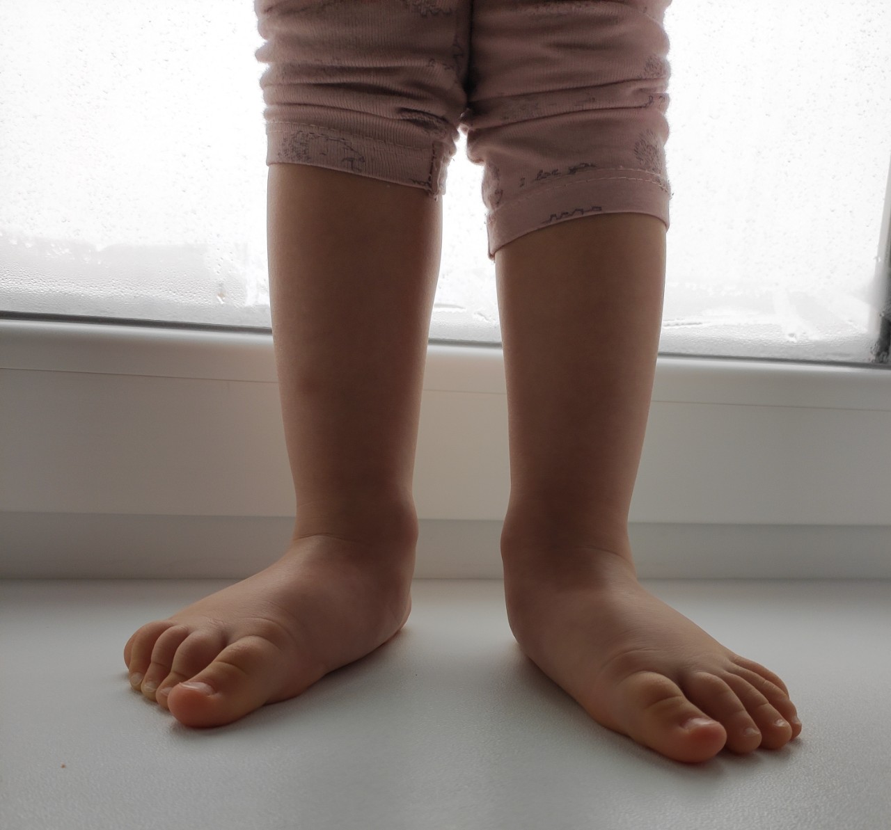 Правильная стопа у ребенка в 2 года фото