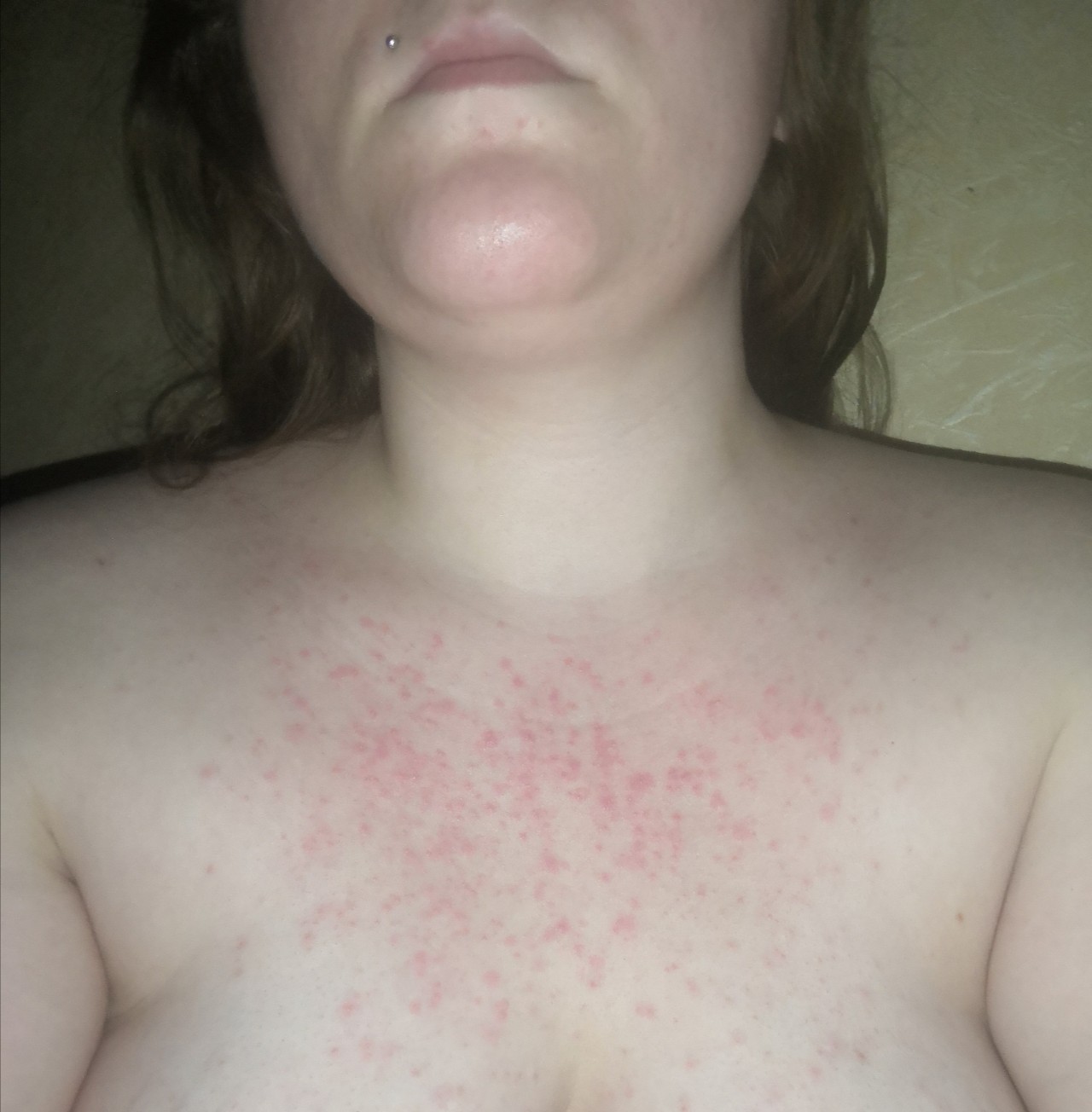 красная сыпь на груди у женщин что это фото 9