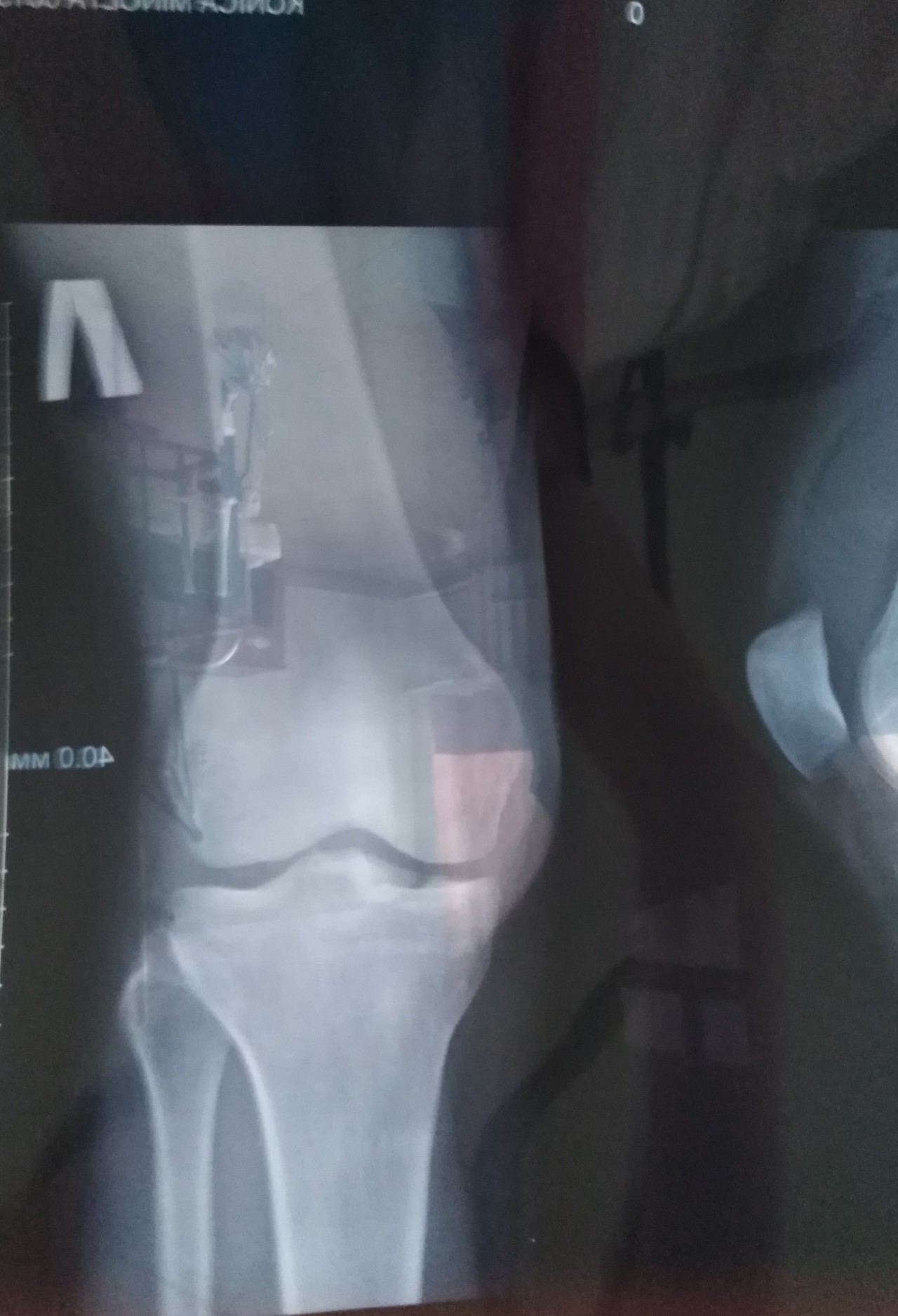 Трещина в коленной. Перелом коленного сустава. Перелом в области коленного сустава. Перелом коленной чашечки. Усталостный перелом колена.