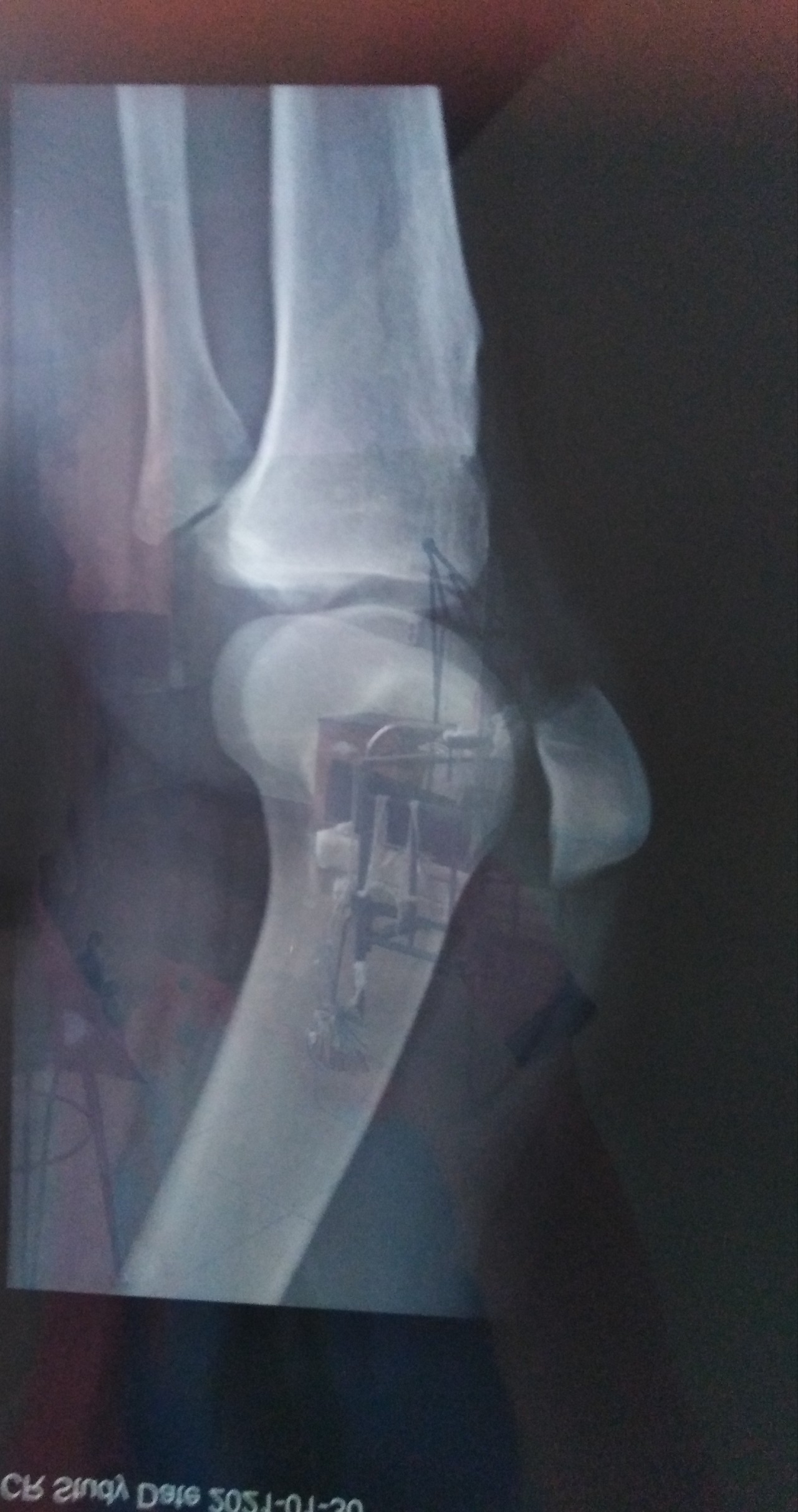 Трещина в коленной. Перелом в области коленного сустава. Перелом коленной чашечки.