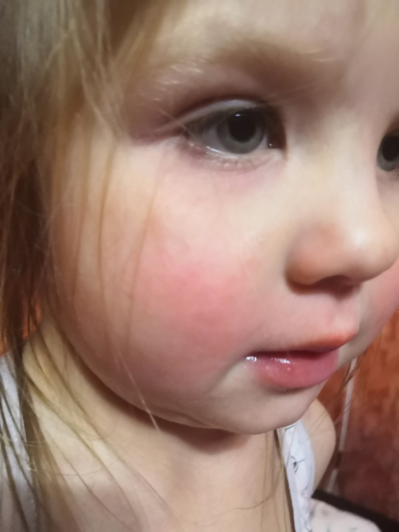 Покраснения на щеках ребенка возрастом 9 месяцев