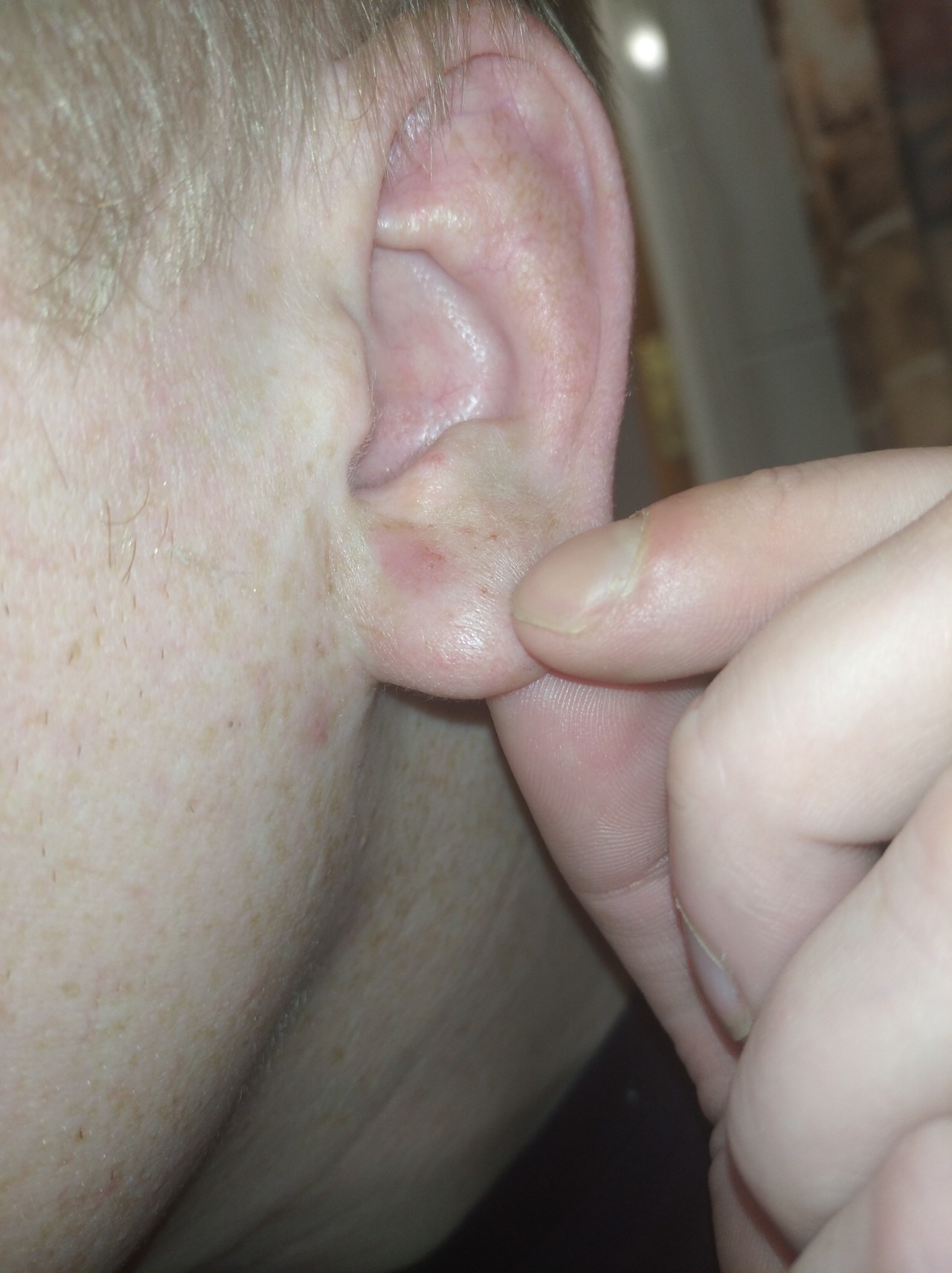 Причины появления уплотнения в мочку уха