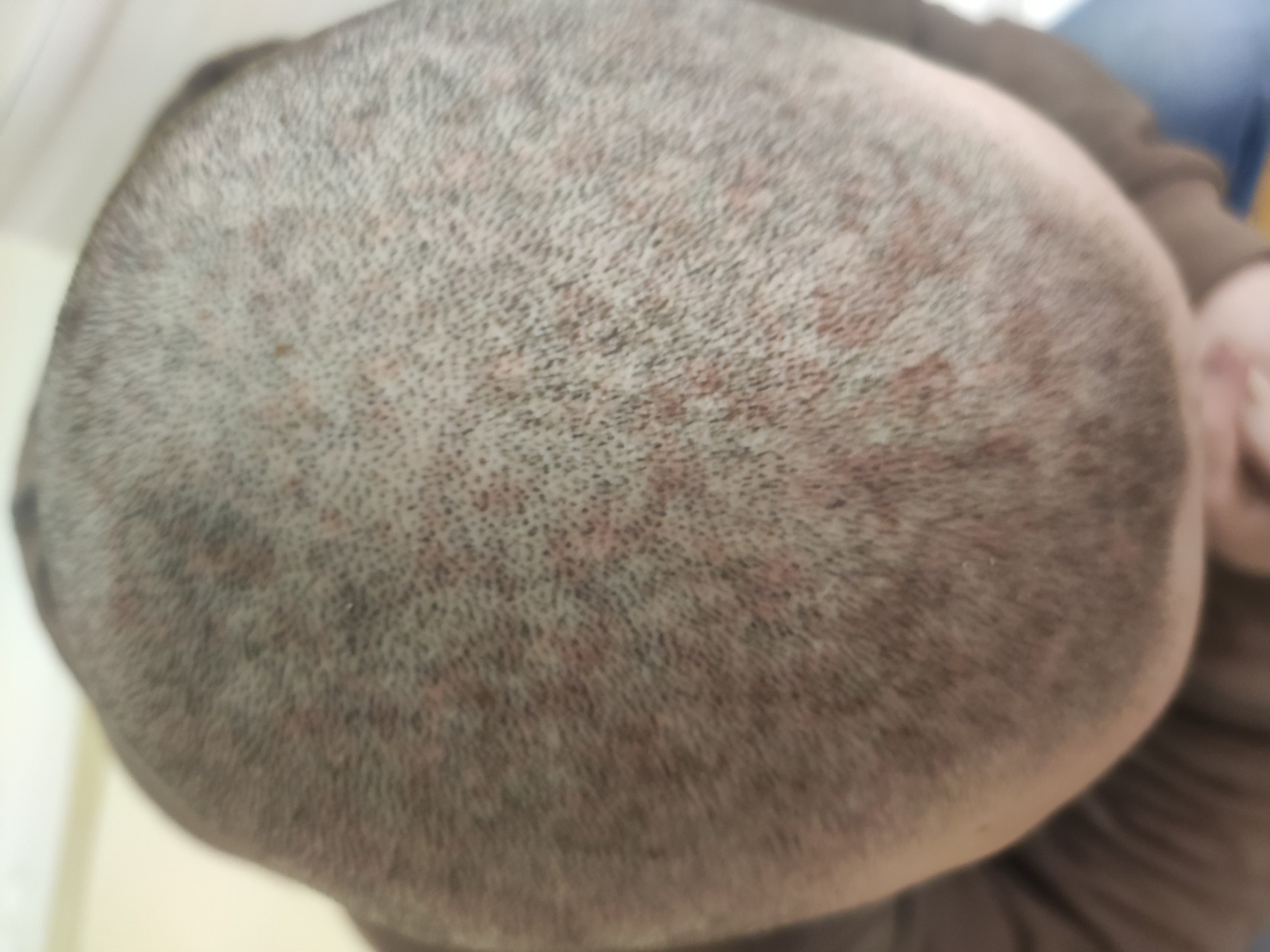 Псориаз на голове у мужчин фото