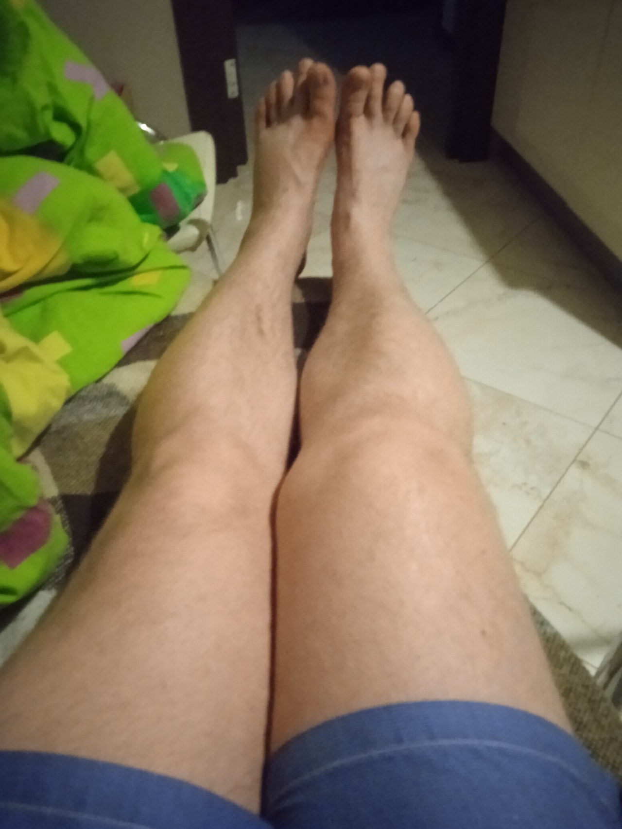 Нога после замены сустава