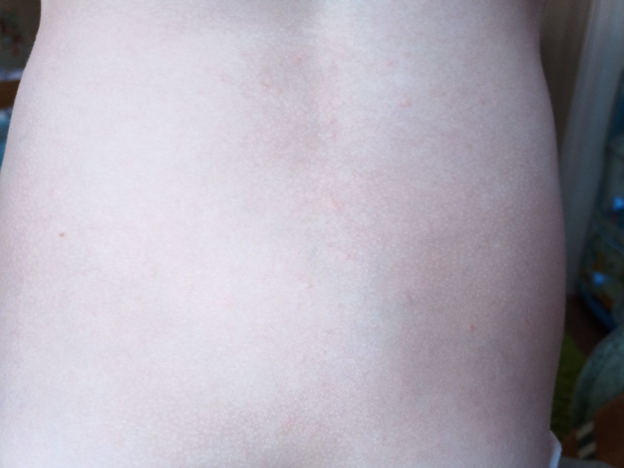 красная сыпь на груди при беременности фото 89