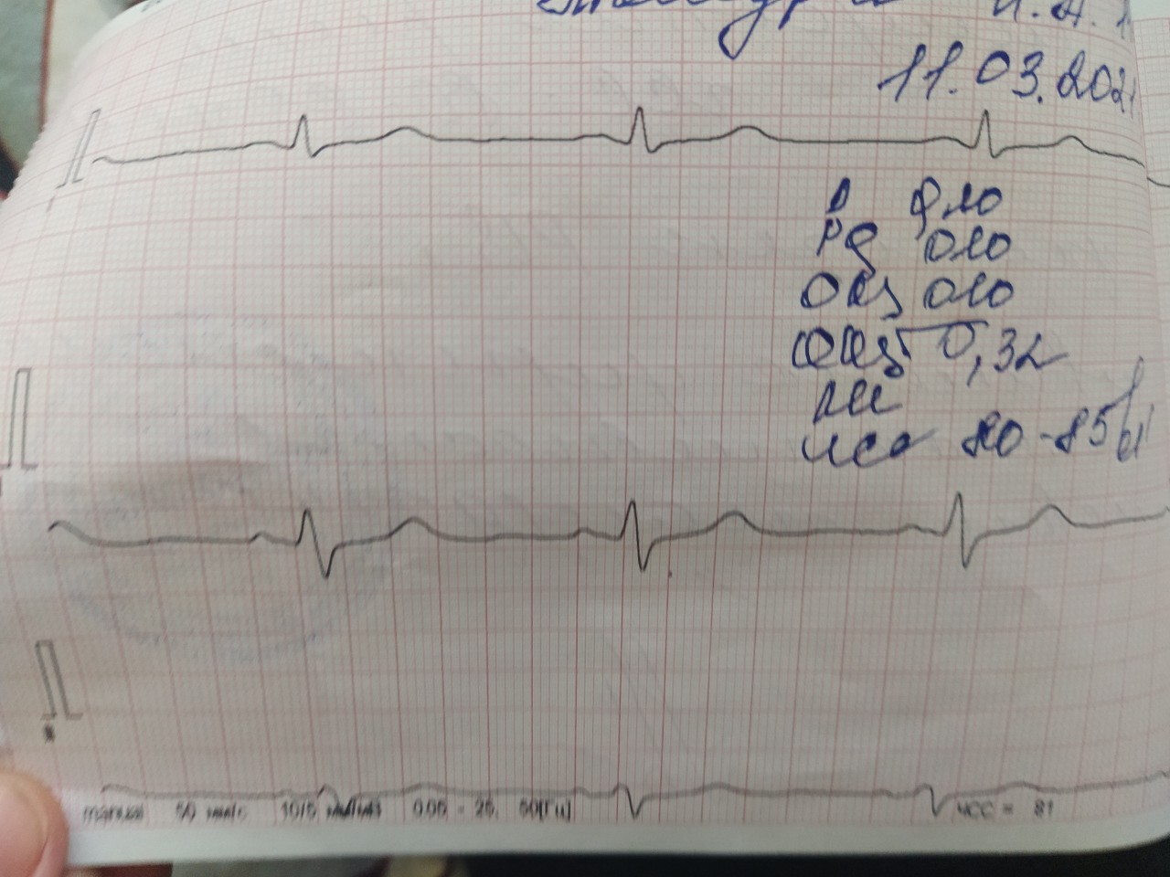 Как выглядит нормальная кардиограмма сердца у взрослых фото