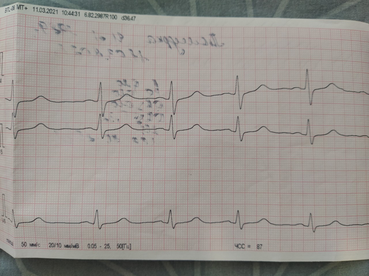 Как выглядит нормальная кардиограмма сердца у взрослых фото