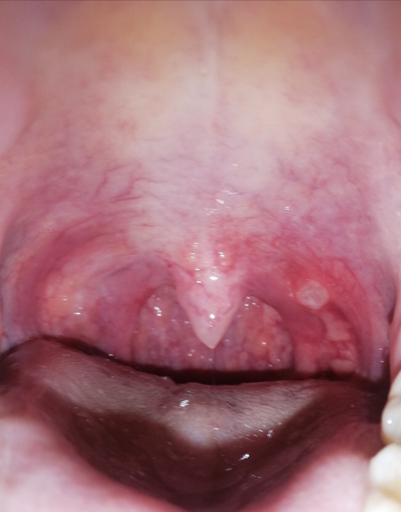 Боль в горле и другие сигналы хронического тонзиллита