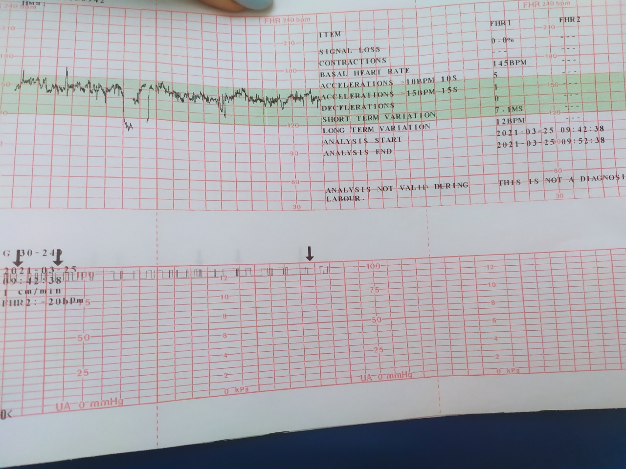 Ктг при схватках фото показатели