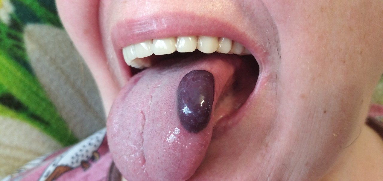 Кровяной шарик во рту: что это такое и что с ним делать