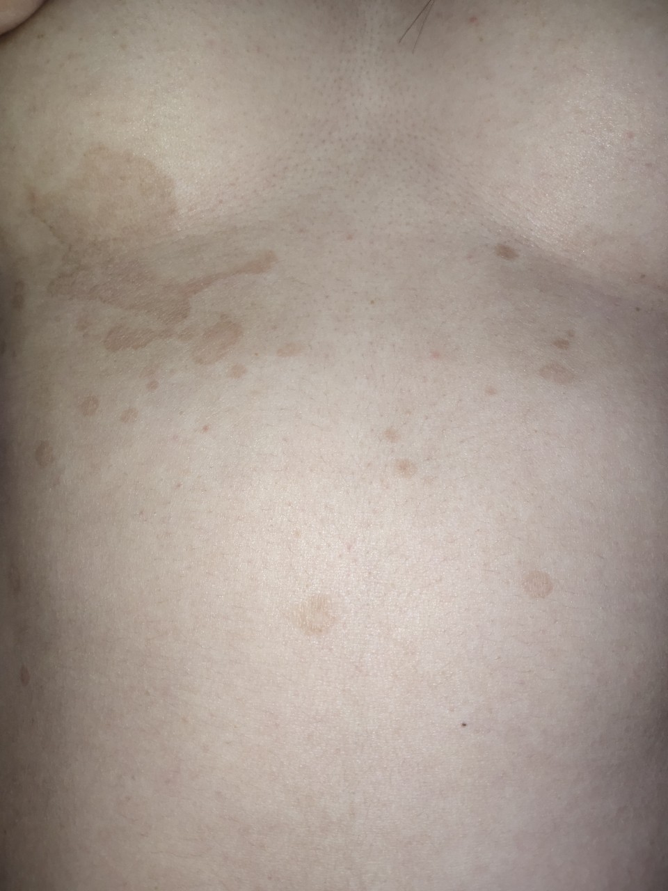 черные точки на груди у женщин фото 12