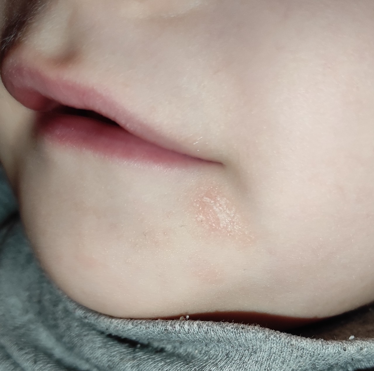 Рыхлое красное горло у ребенка фото