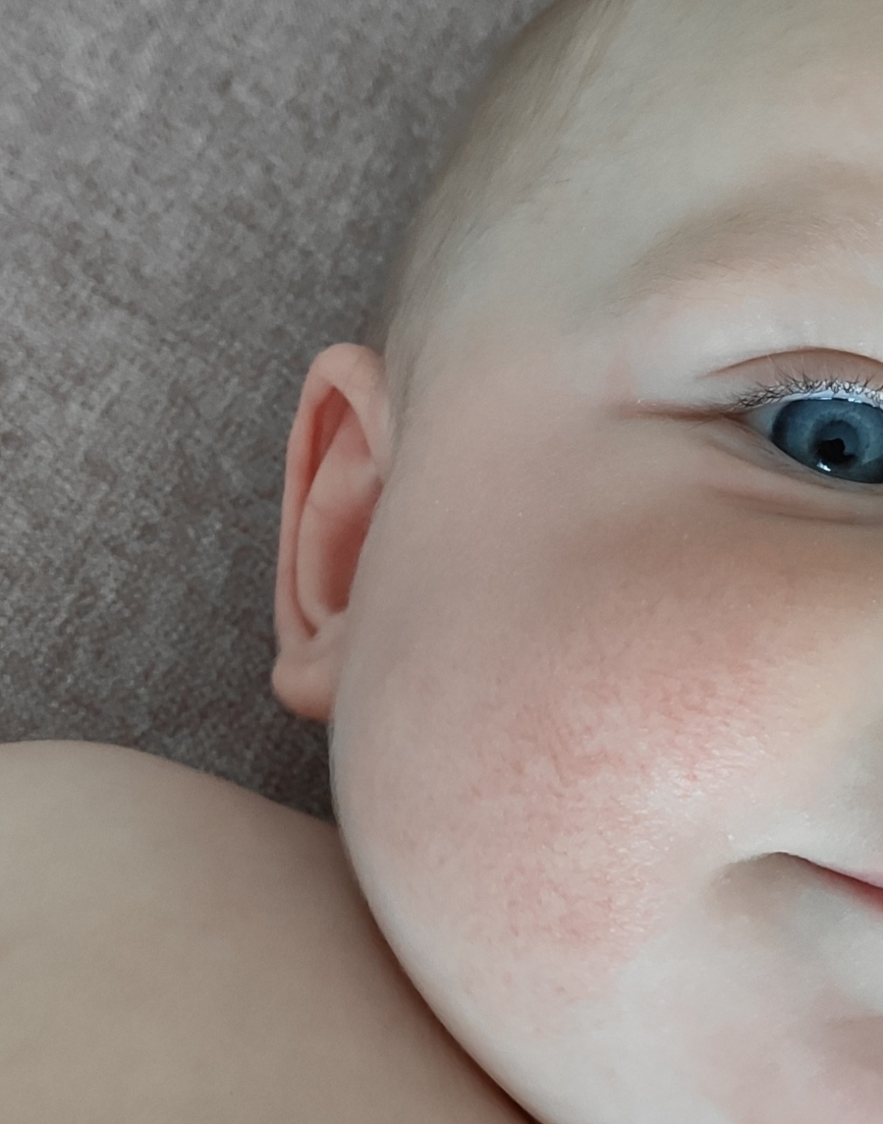 Ребенку год красные щеки. Пищевая аллергия на щеках у ребенка.