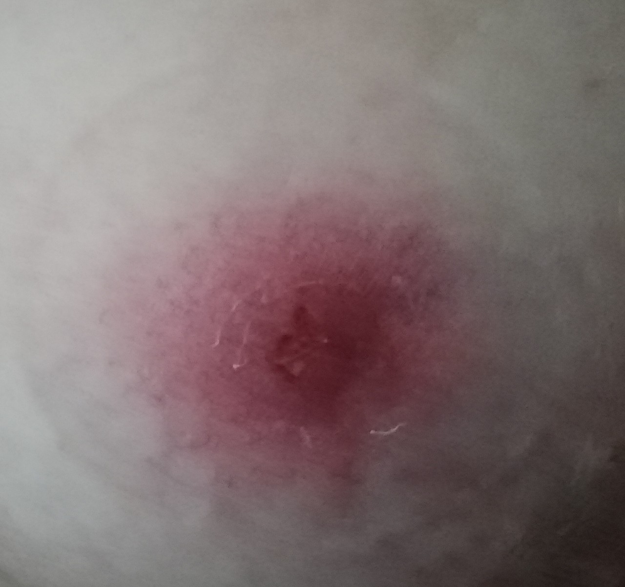 появилось красное пятно на груди при беременности (120) фото