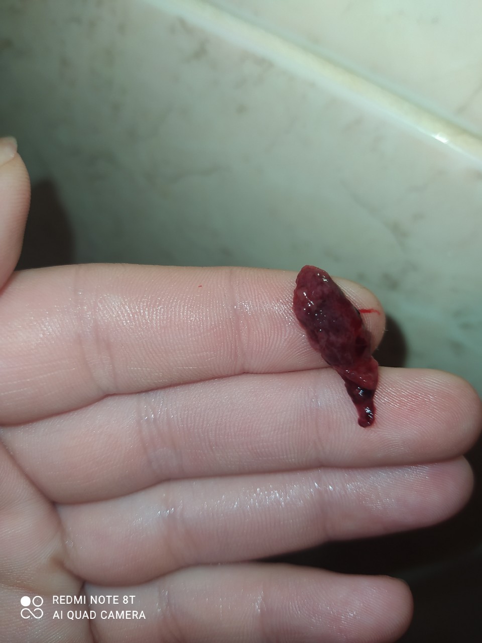 сгустки крови в сперме мужчин фото 36