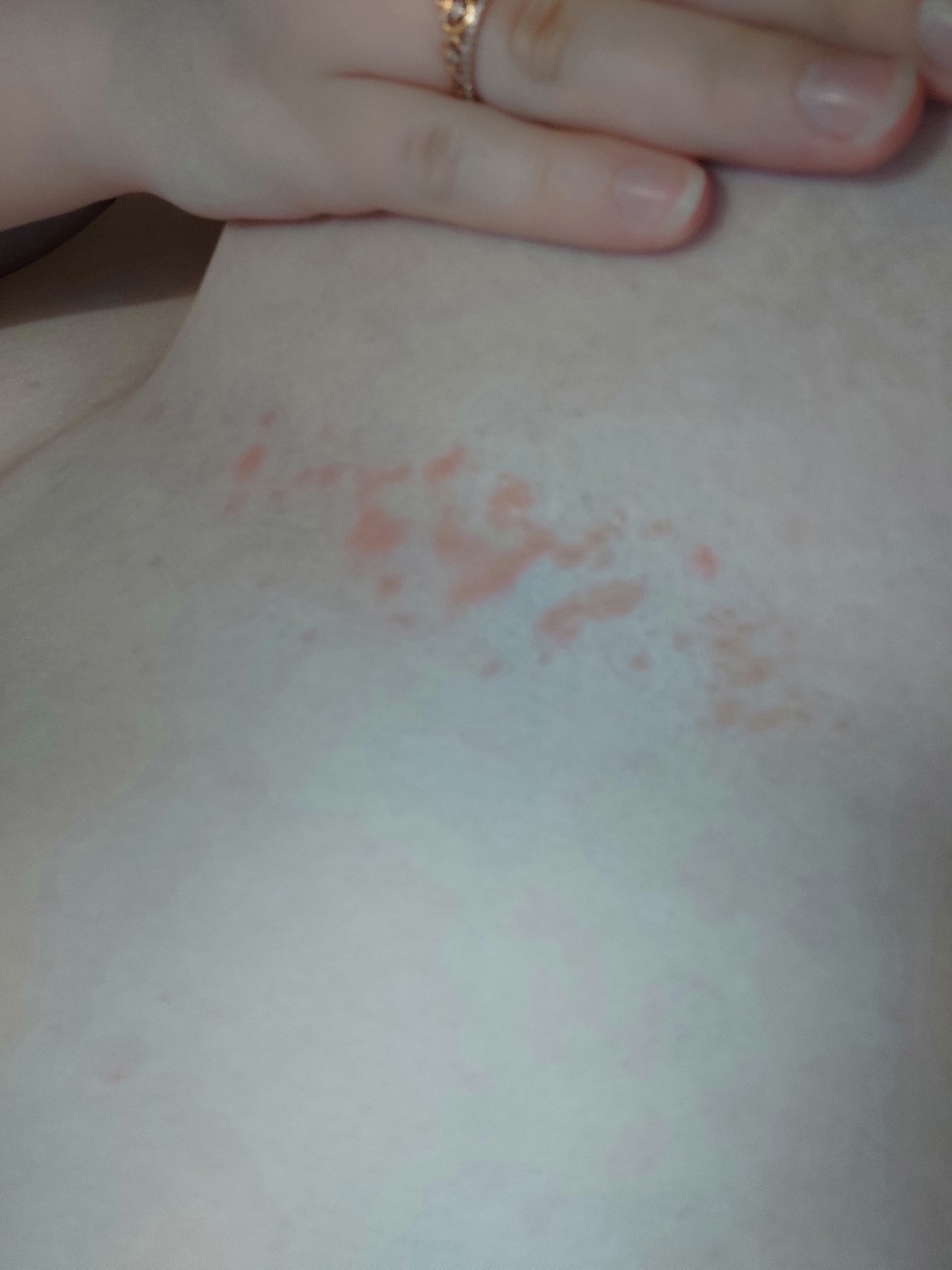 красное пятно на груди у женщин фото 44