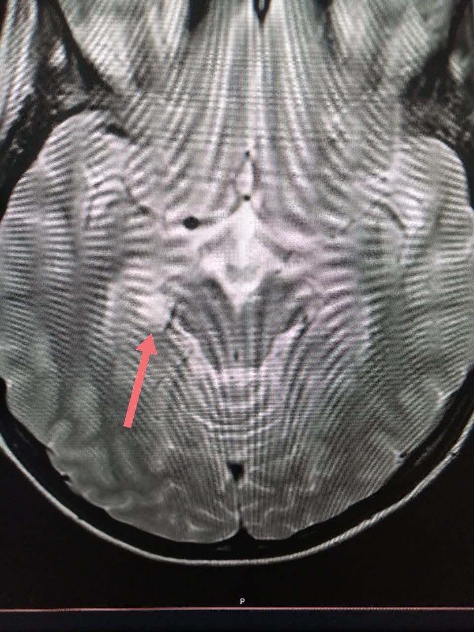 Аневризма головного мозга фото на мрт