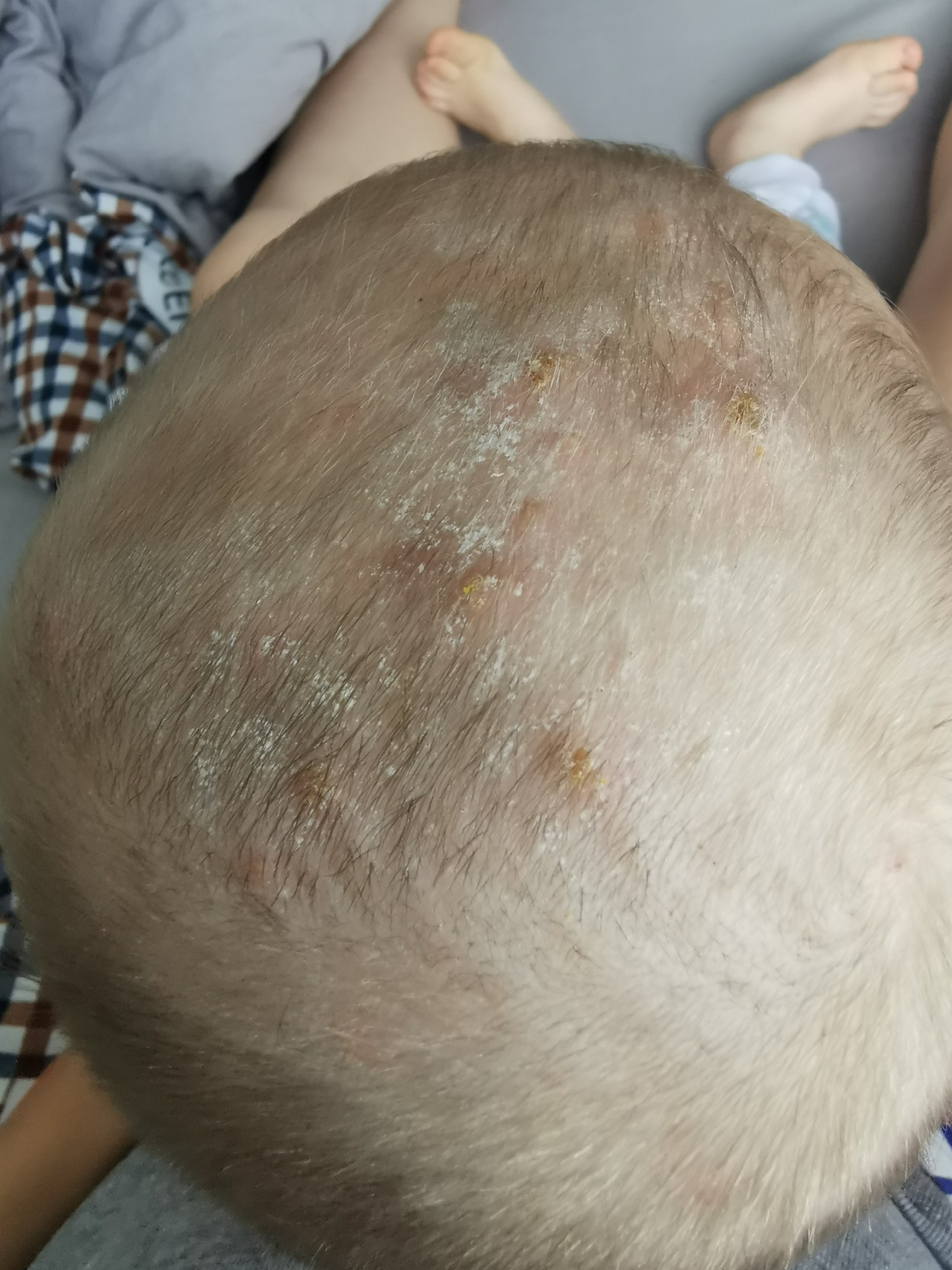 Себорейный дерматит кожи головы лечение фото
