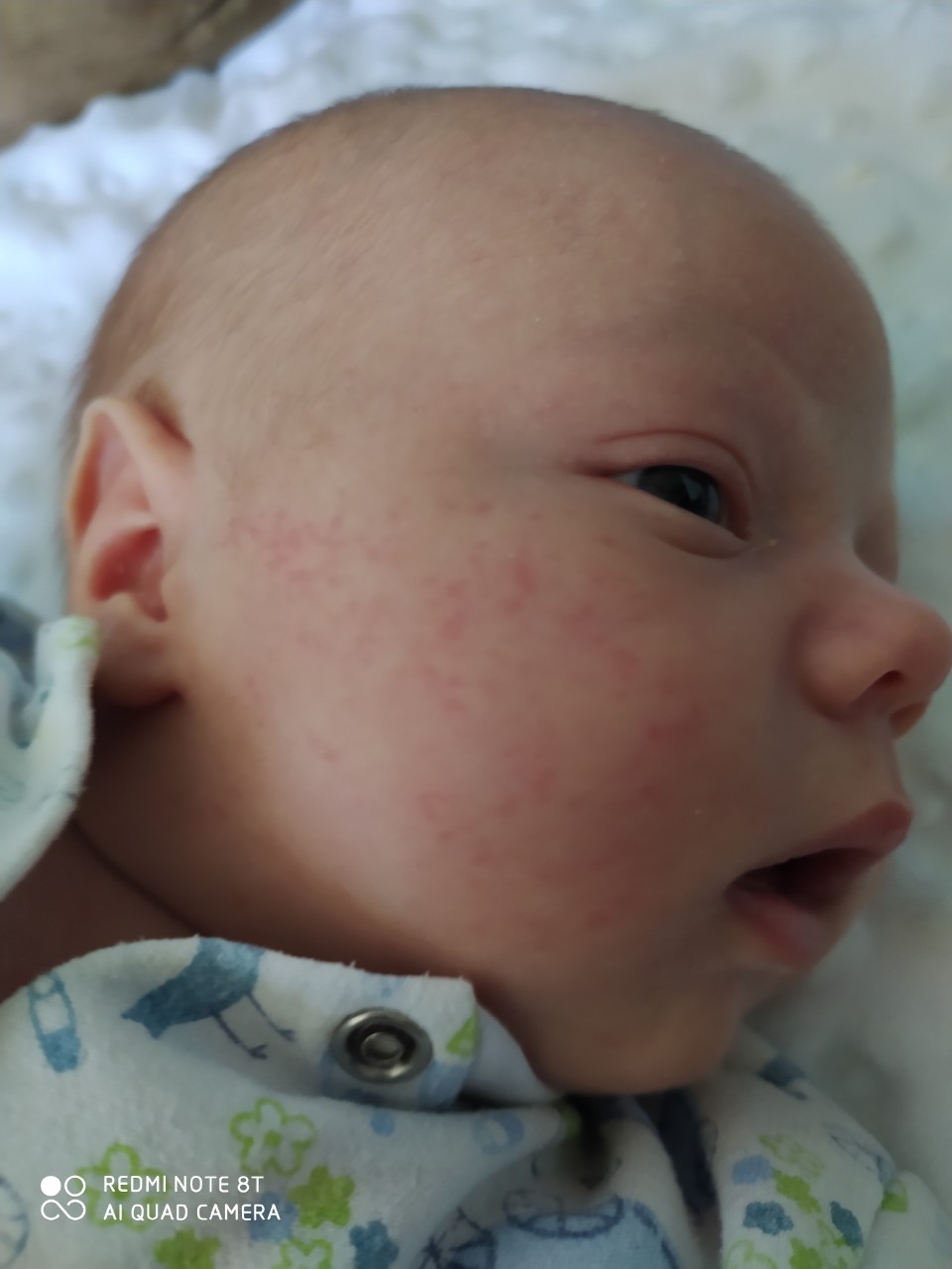 Высыпания на лице у младенца в 1 месяц