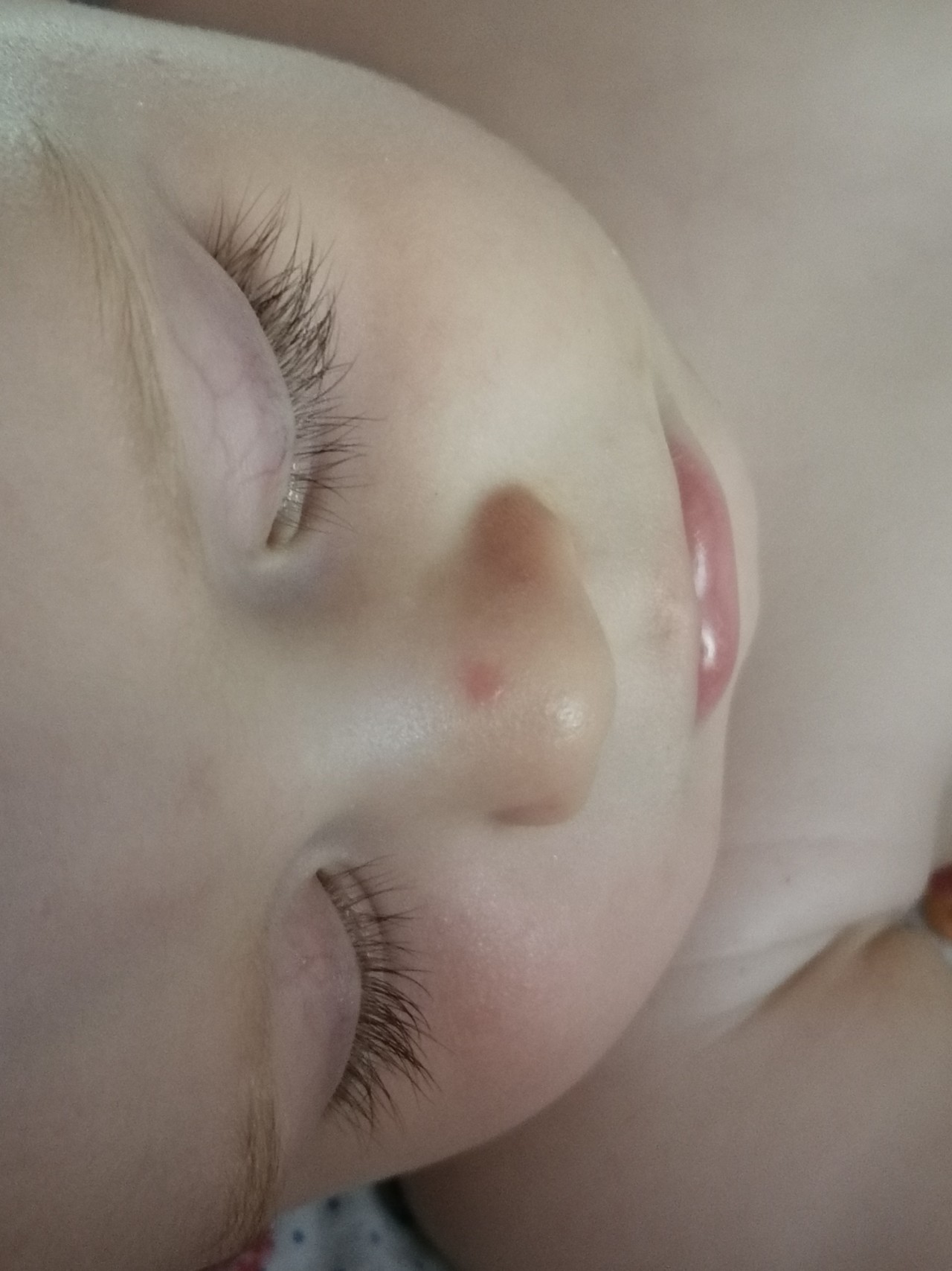Пупырышки на носу у ребенка