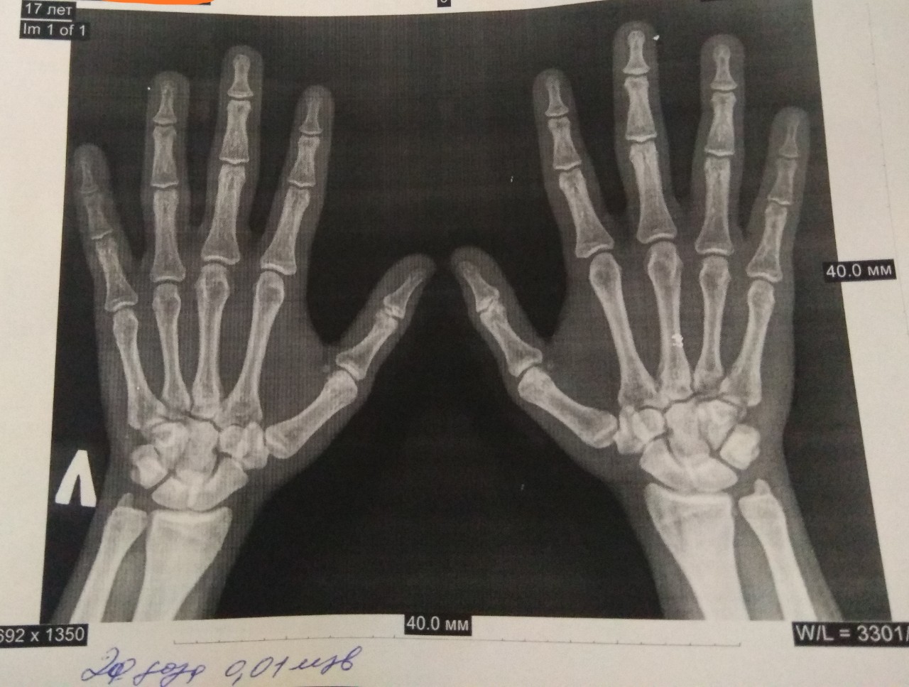 Рентген кисти руки фото здоровой правой