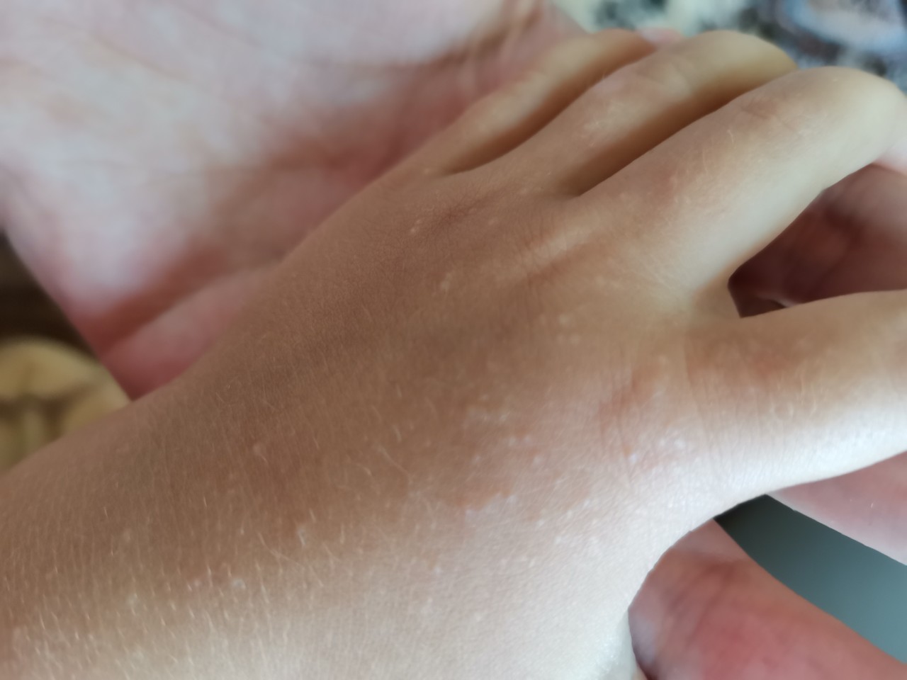 Аллергическая сыпь на руках