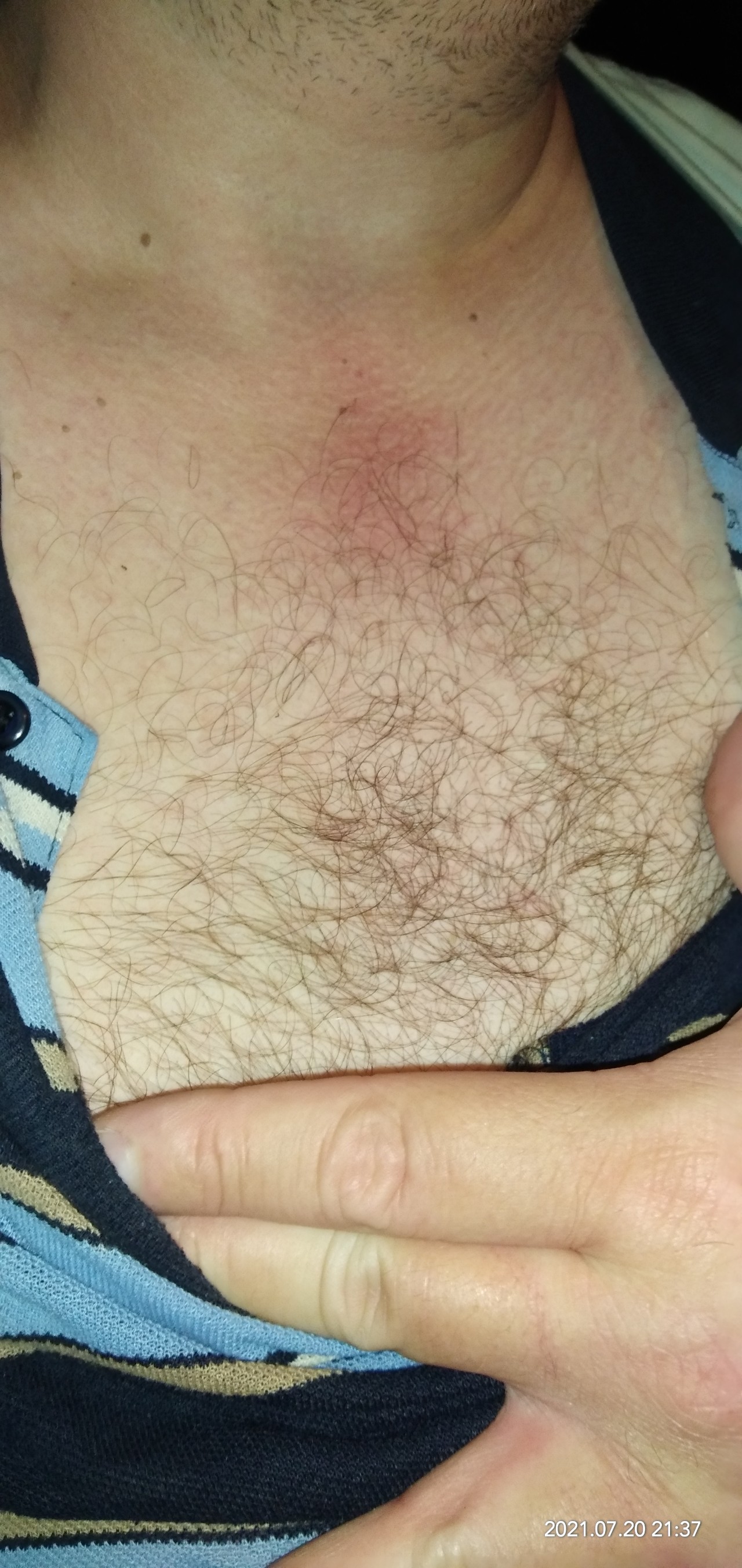 красное уплотнение на груди у мужчин фото 90