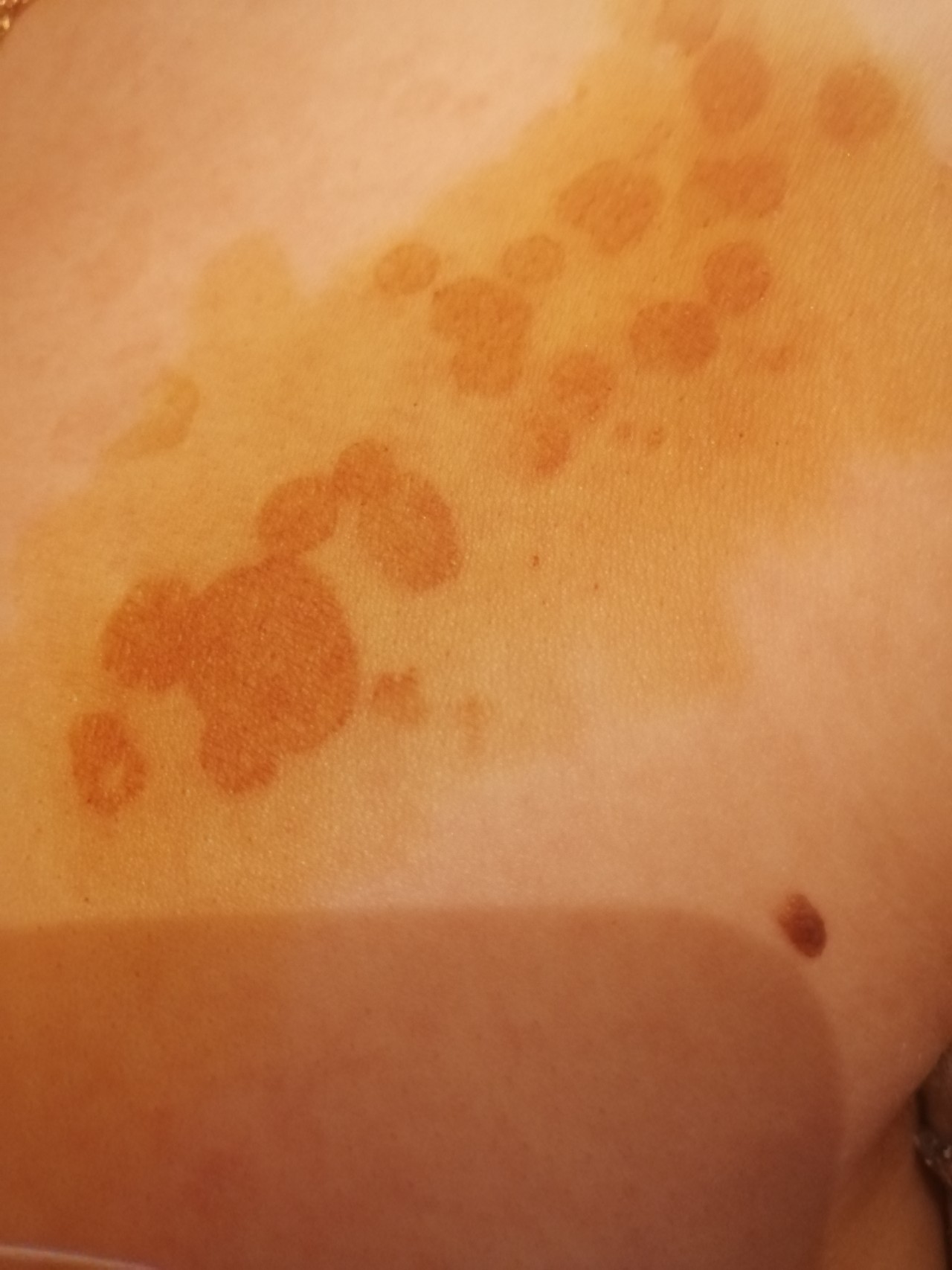 светло коричневые пятна на груди у женщин фото 111