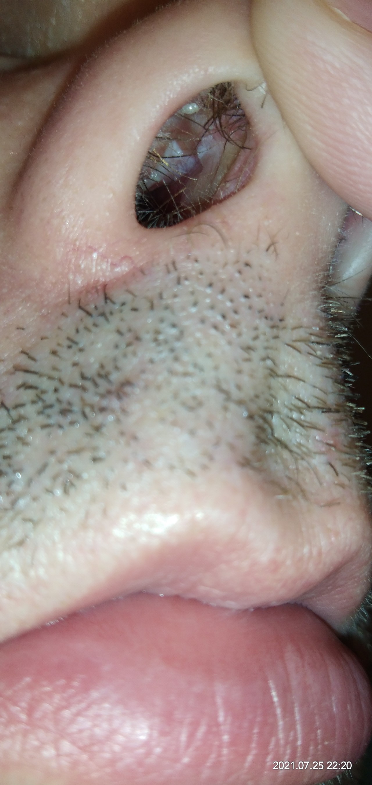 Искривление носовой перегородки – причины, симптомы, лечение