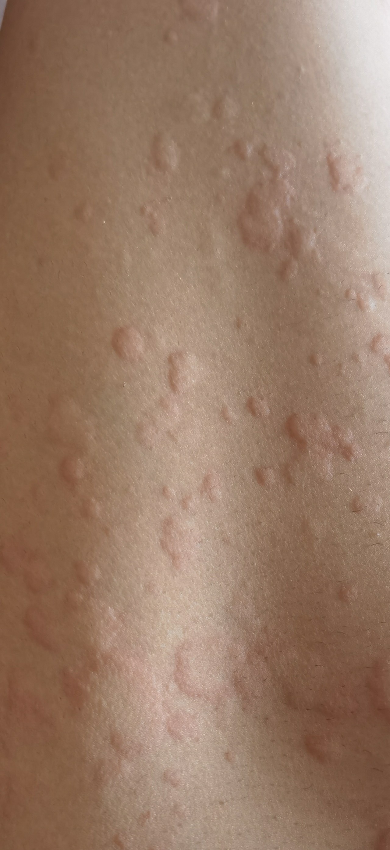 аллергия по телу по сперму фото 43