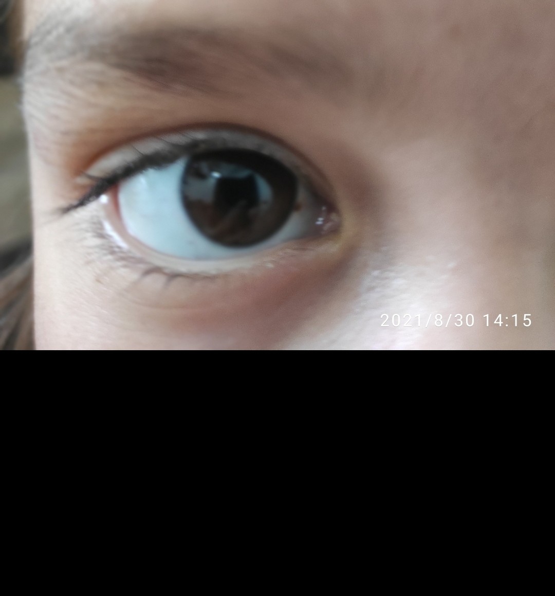 Eye daughter. У подростка не сильно белые белки глаз.