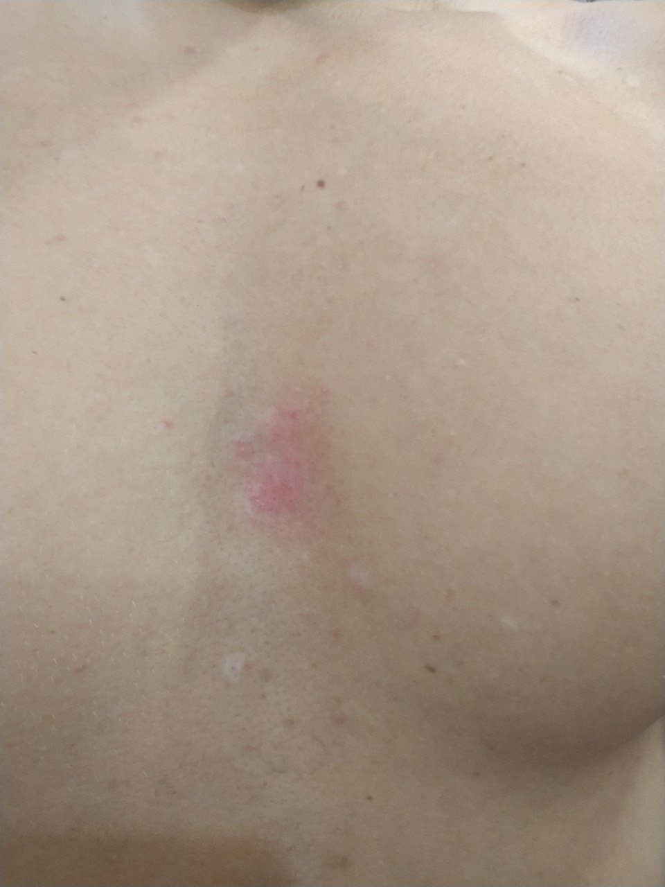 покраснения в области груди у женщин фото 109