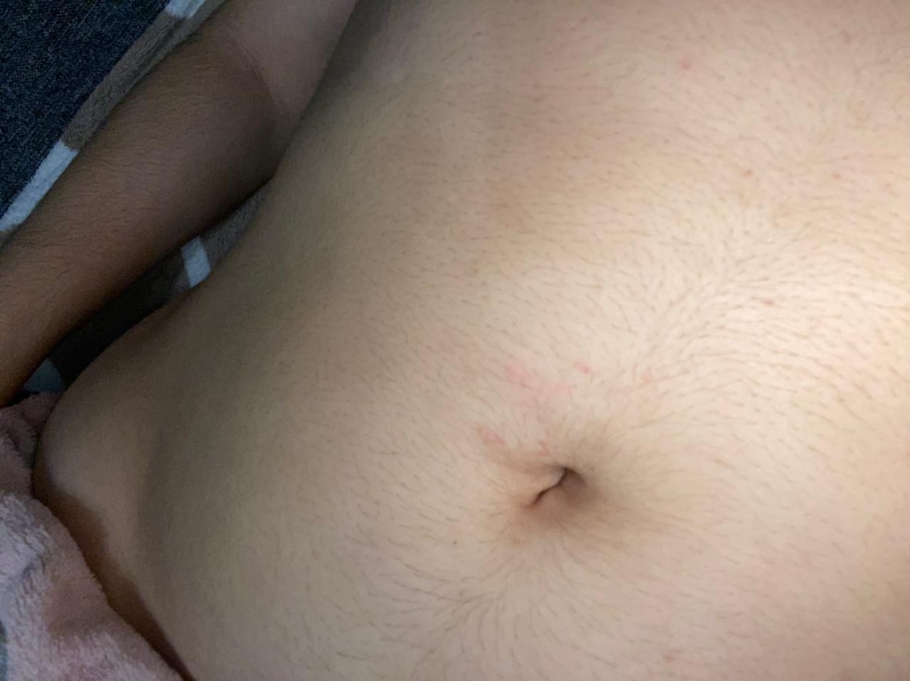 беременность сыпь на животе и груди фото 8