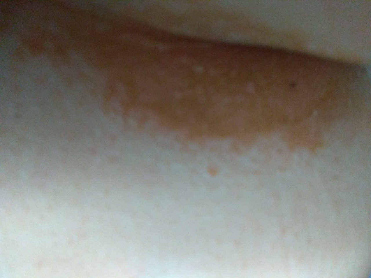 светло коричневые пятна на груди у женщин фото 91