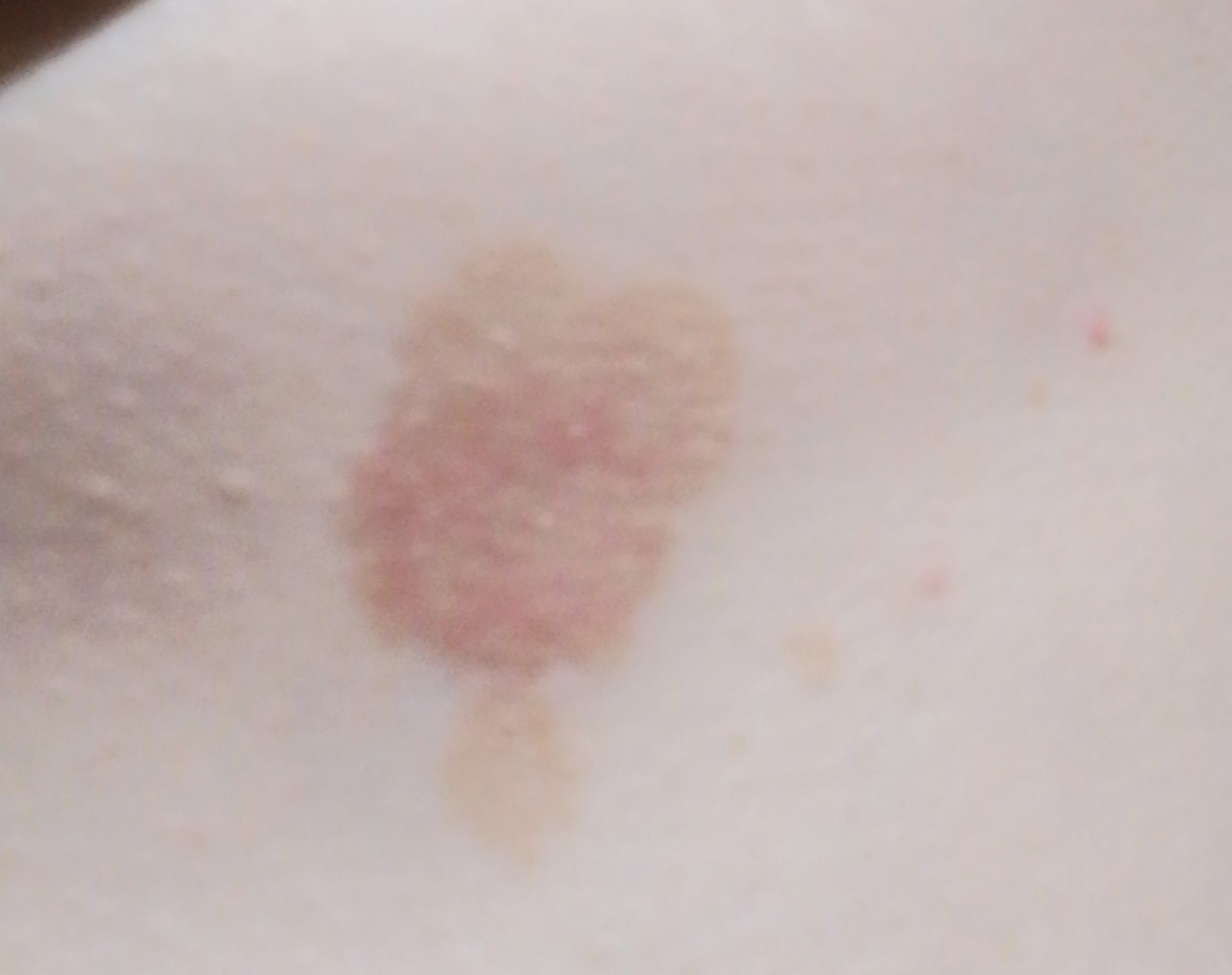 светло коричневые пятна на груди у женщин фото 118