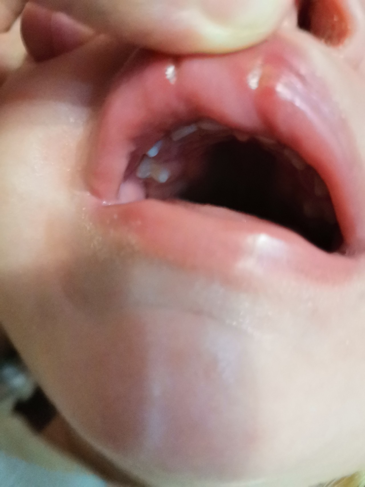 У ребенка опухла верхняя губа: 4 основные причины