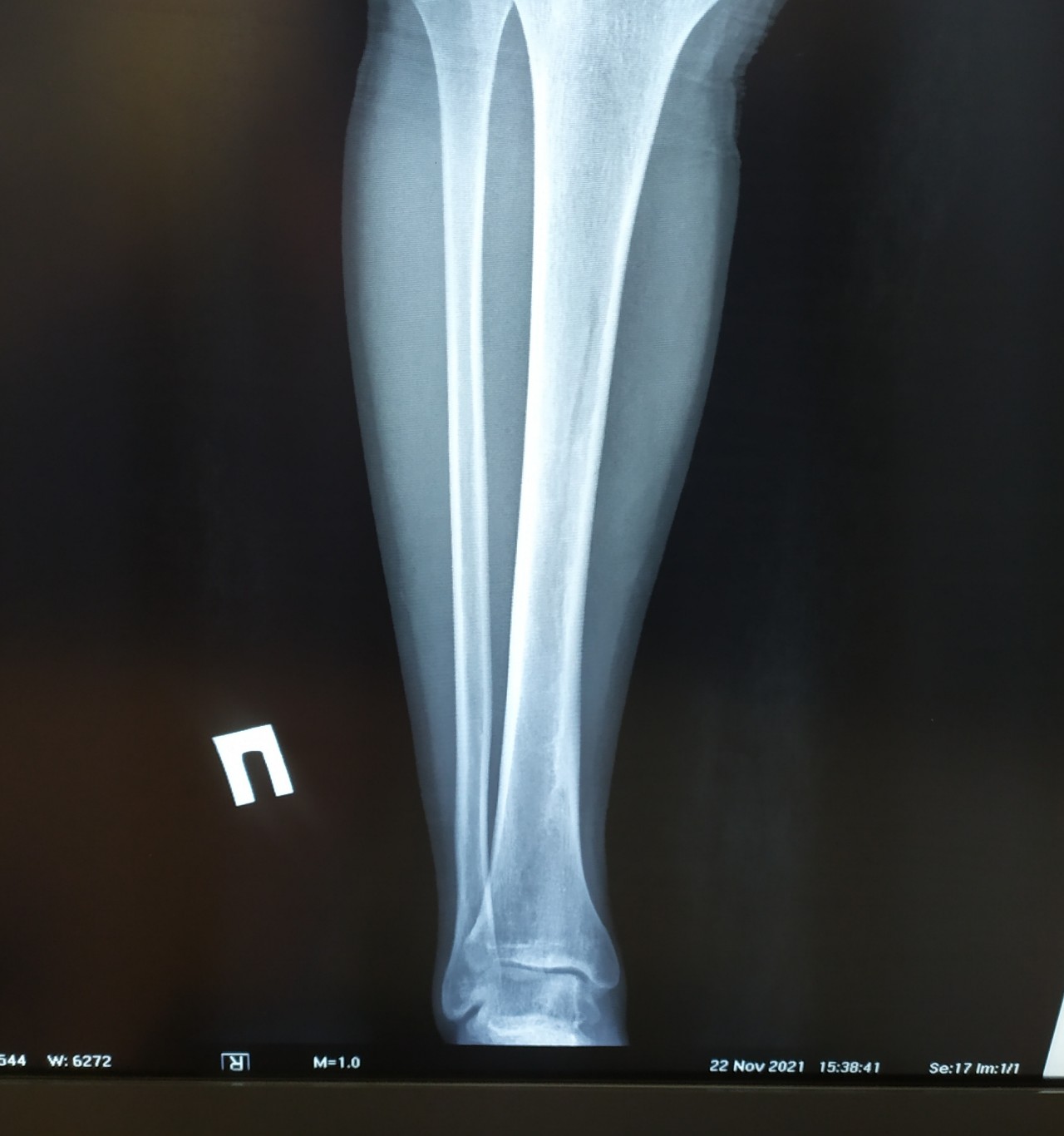 Как долго заживает трещина. Рентген ноги перелом малой берцовой кости. Перелом малой берцовой кости рентген. Перелом 1/3 малой берцовой кости. Винтовой перелом малой берцовой кости.
