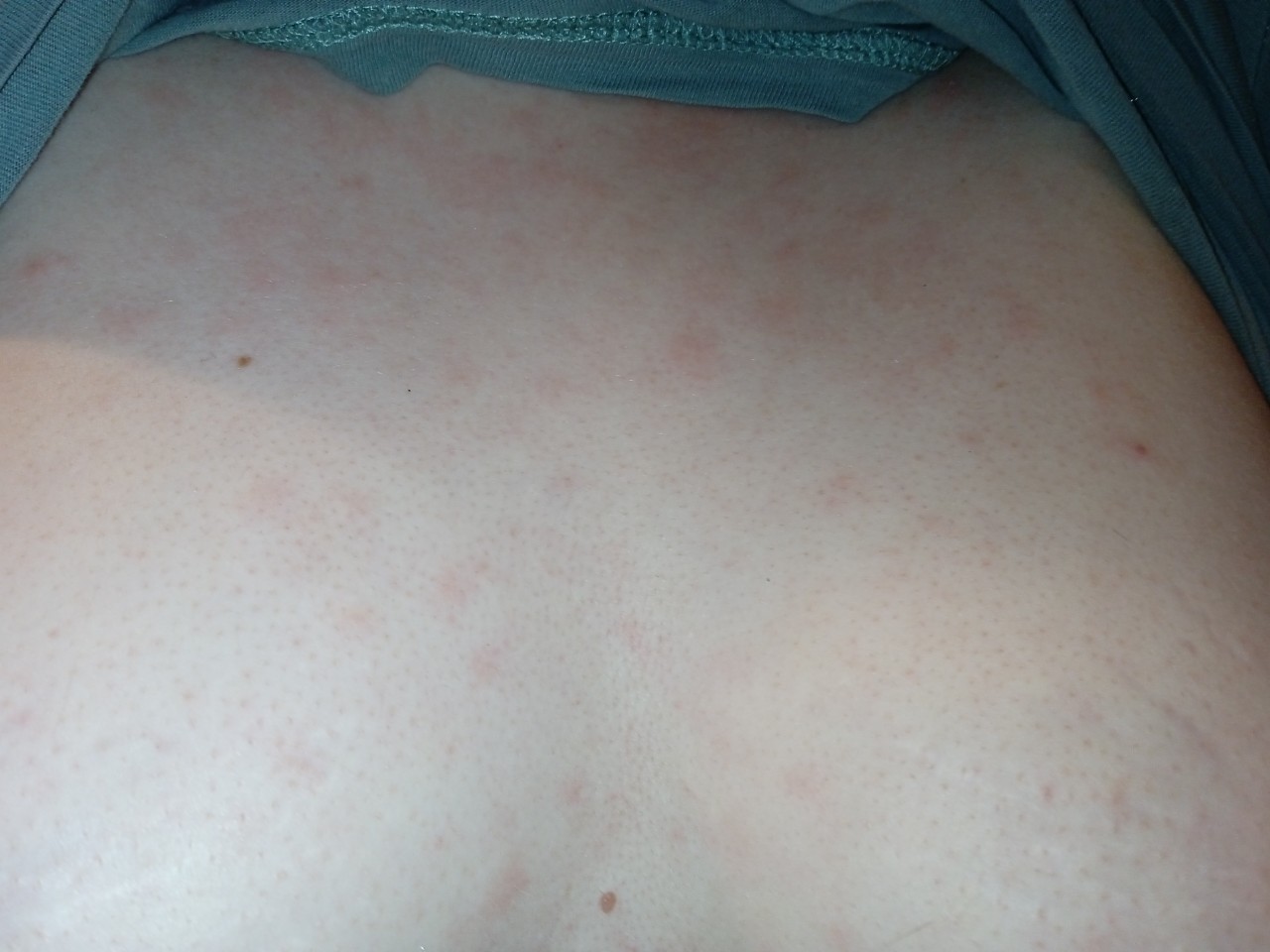 аллергия по телу по сперму фото 100