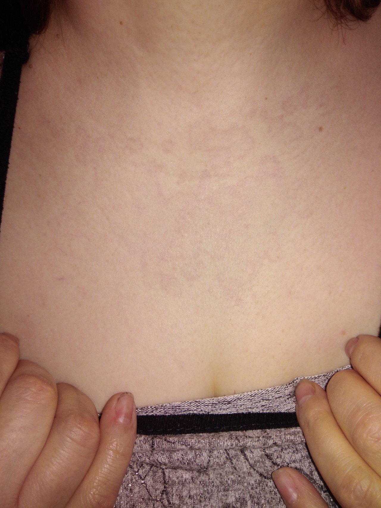 аллергия на груди у беременной фото 29